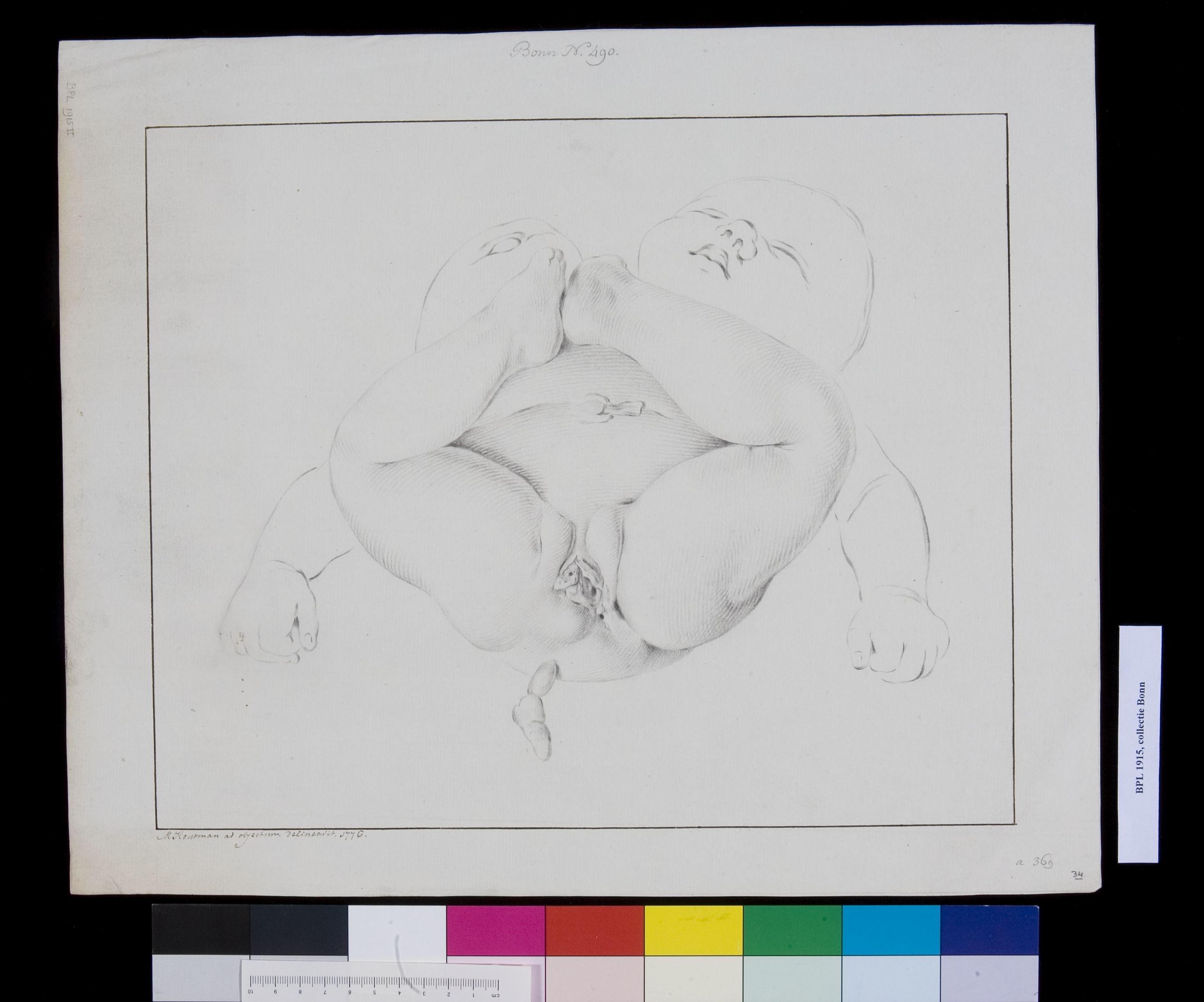 Conjoined twins