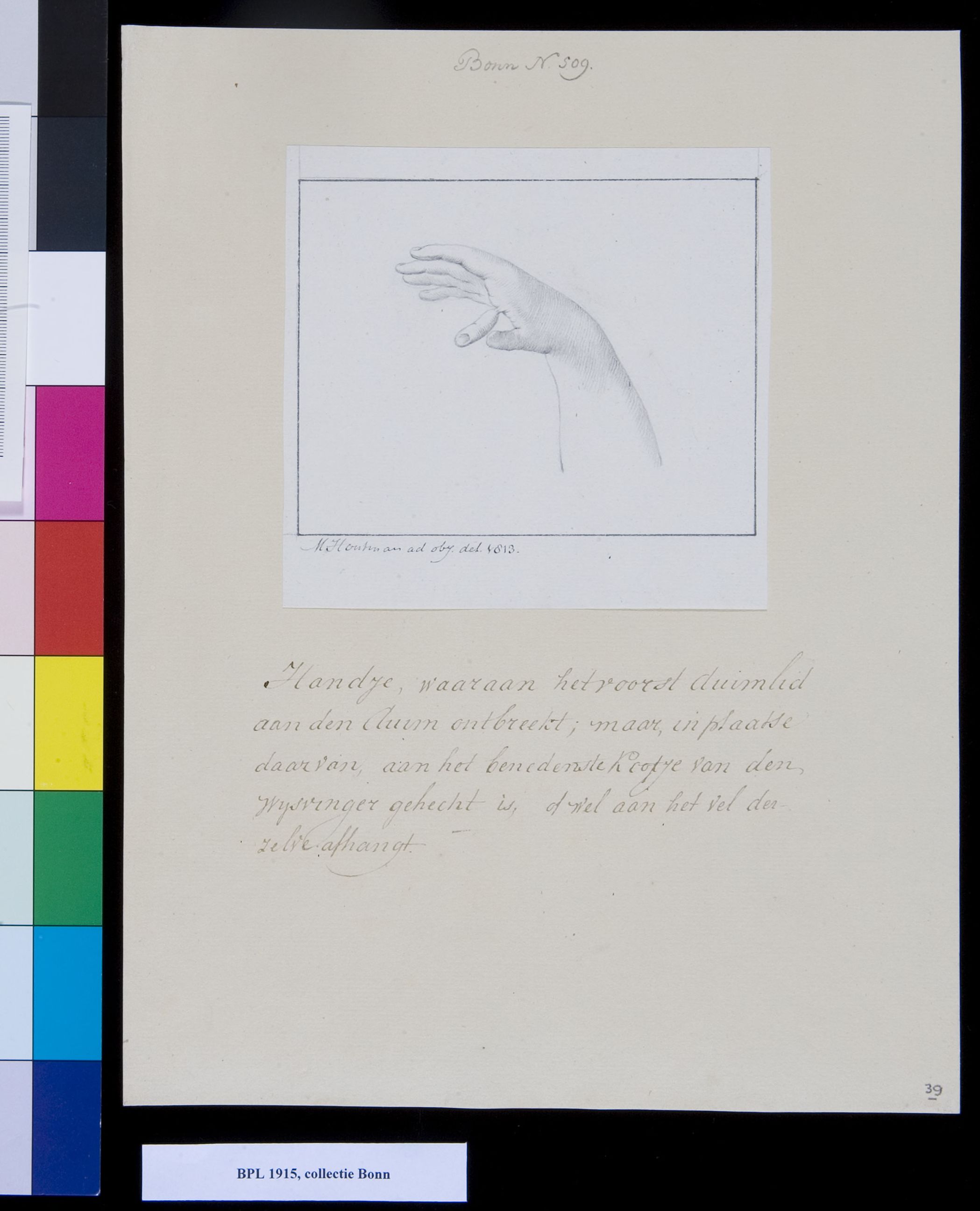 hand with incomplete thumb and extra finger