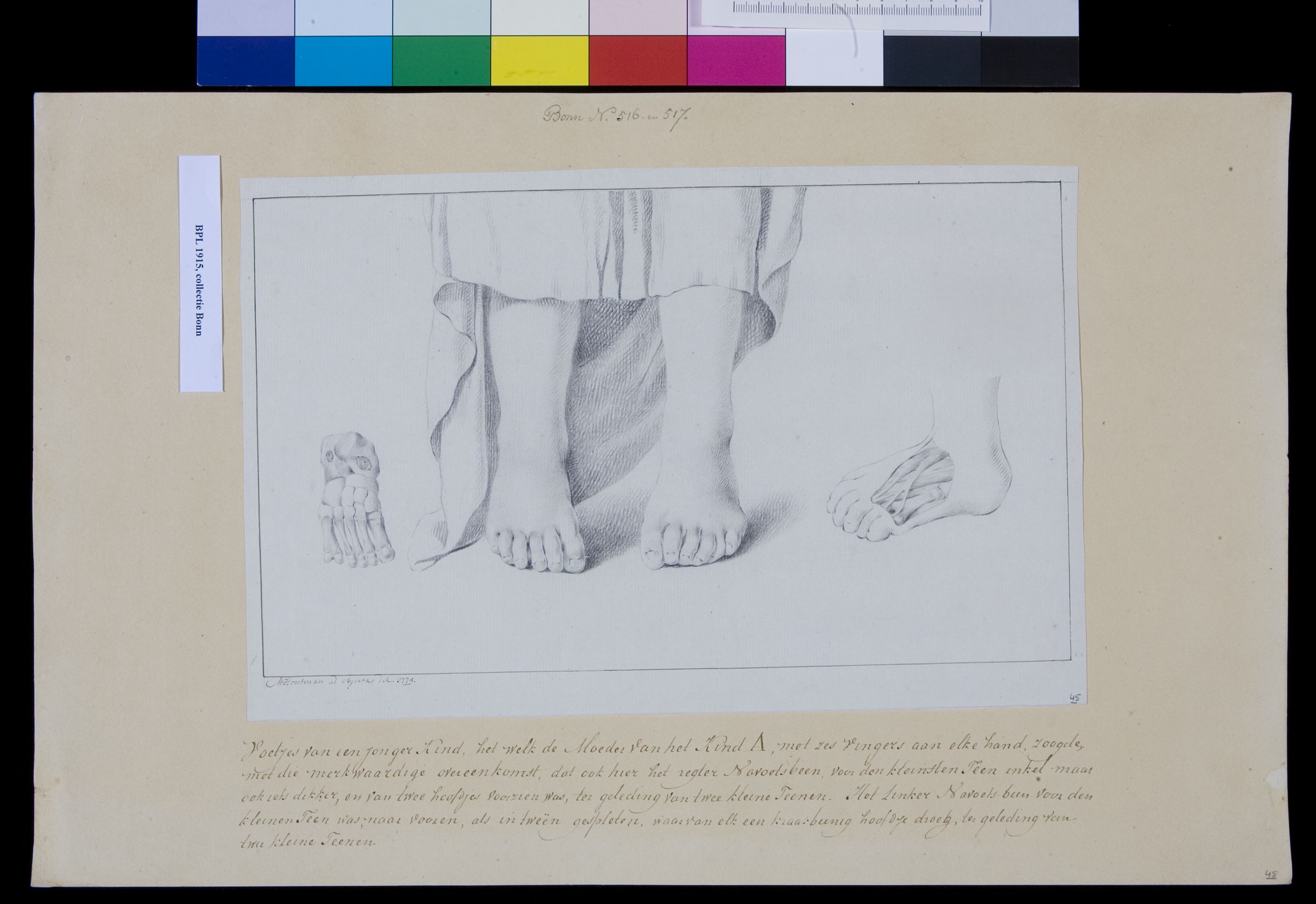 Children's feet with six toes