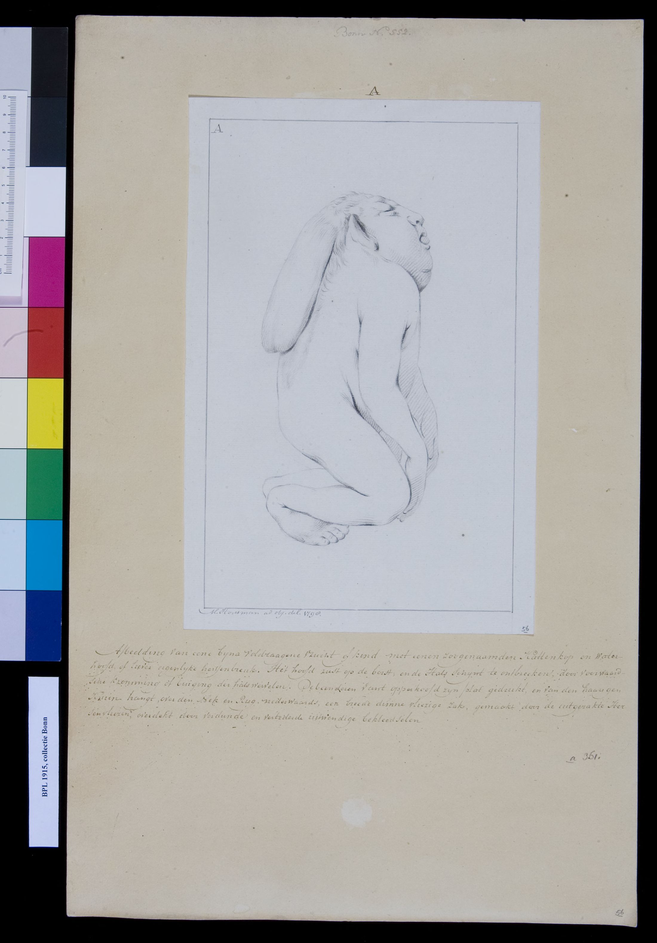 Deformed foetus