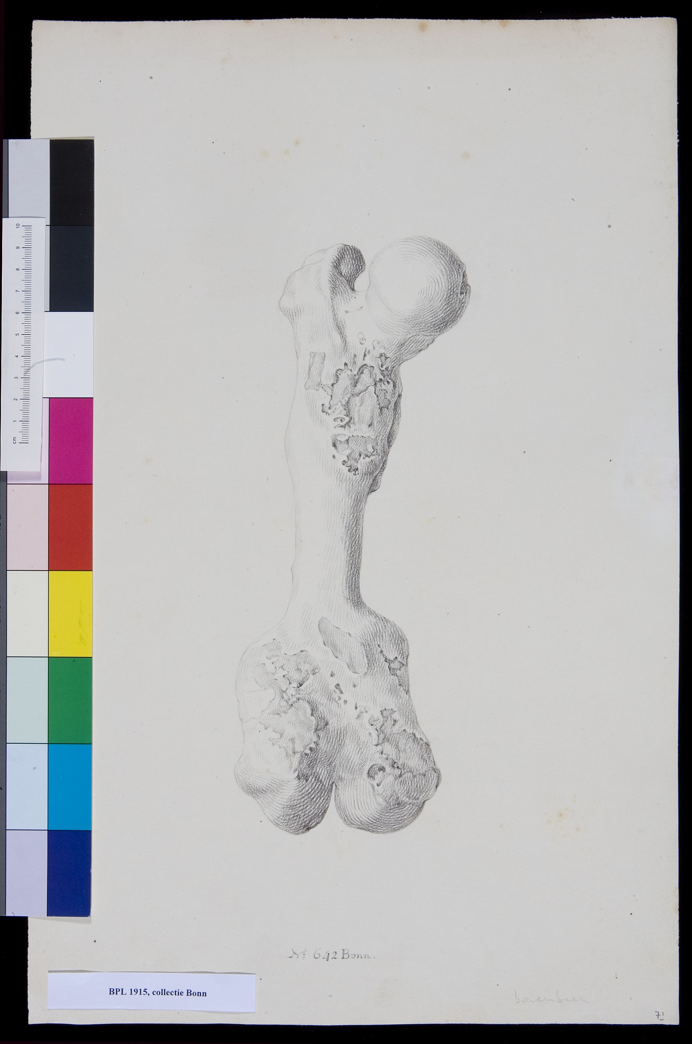 Bone of the upper leg (femur)