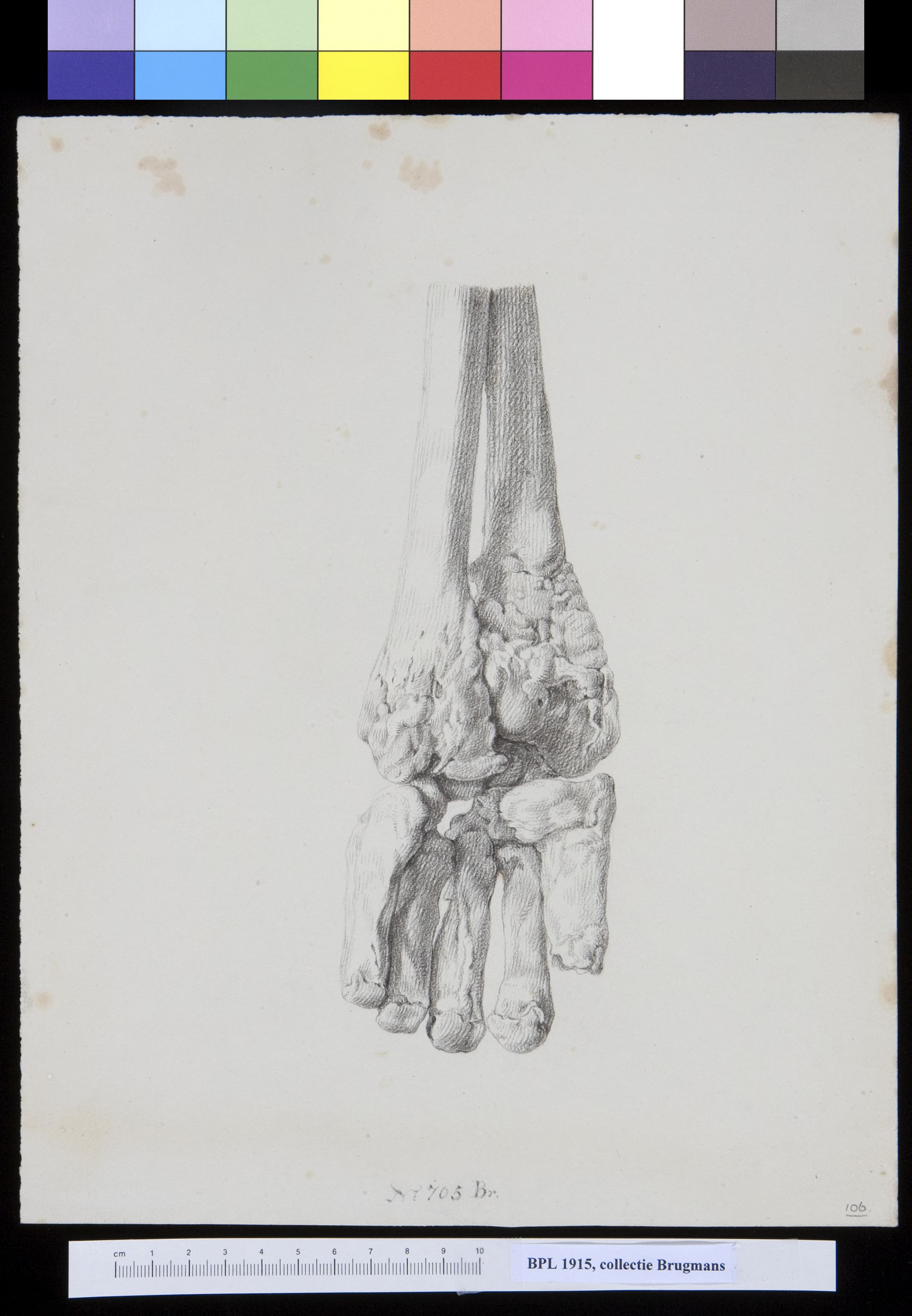 Hand and lower arm (ulna and radius)