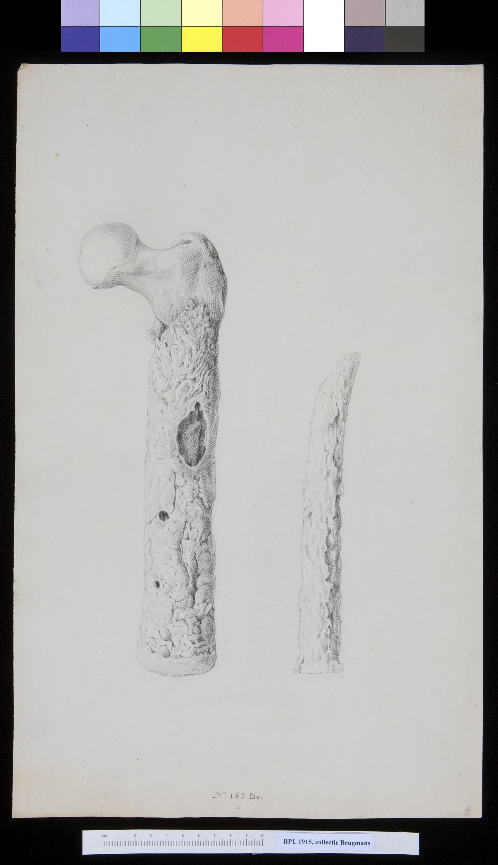 Bone of the upper leg (femur)