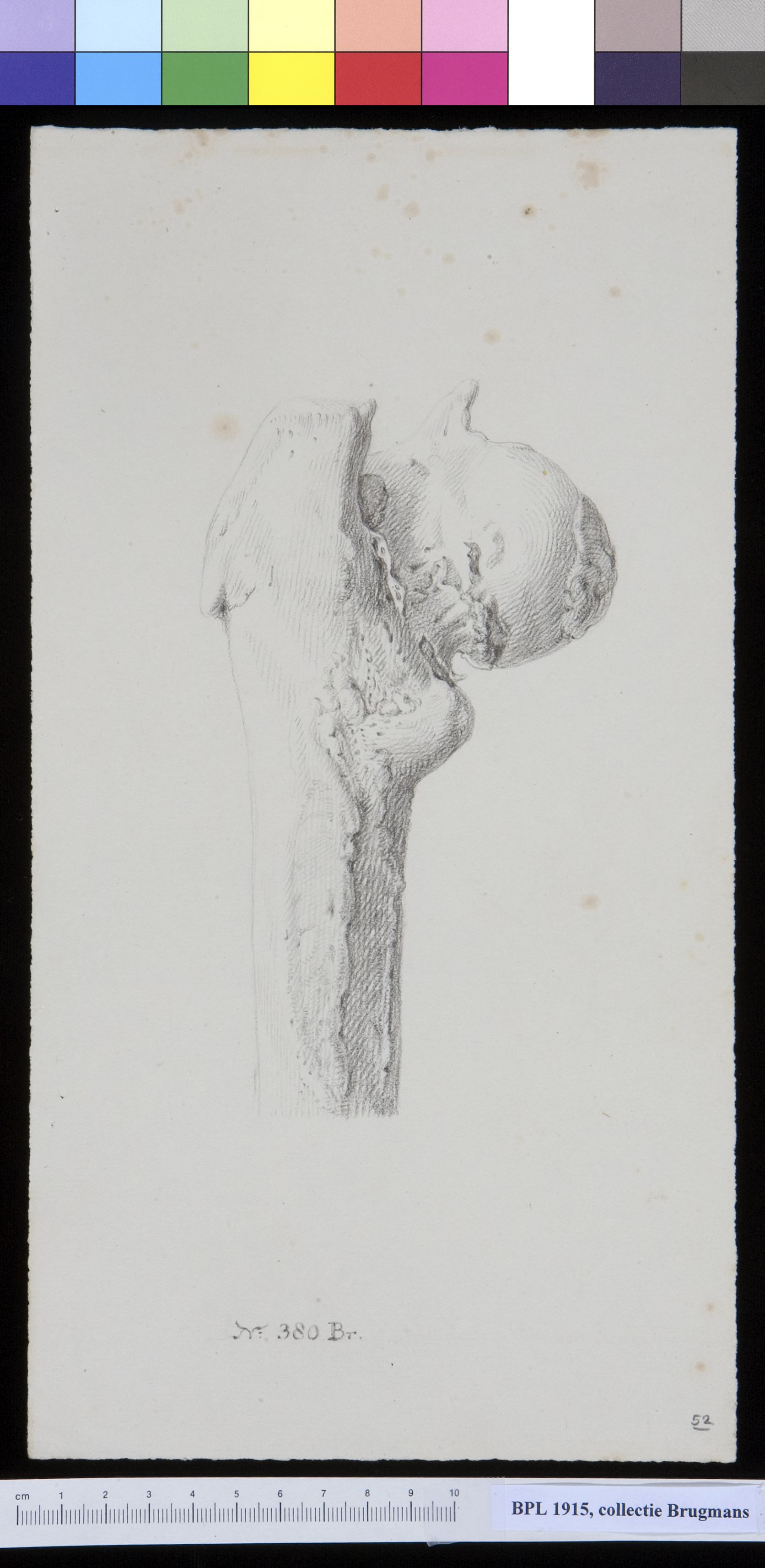 Bone of the upper leg (femur)