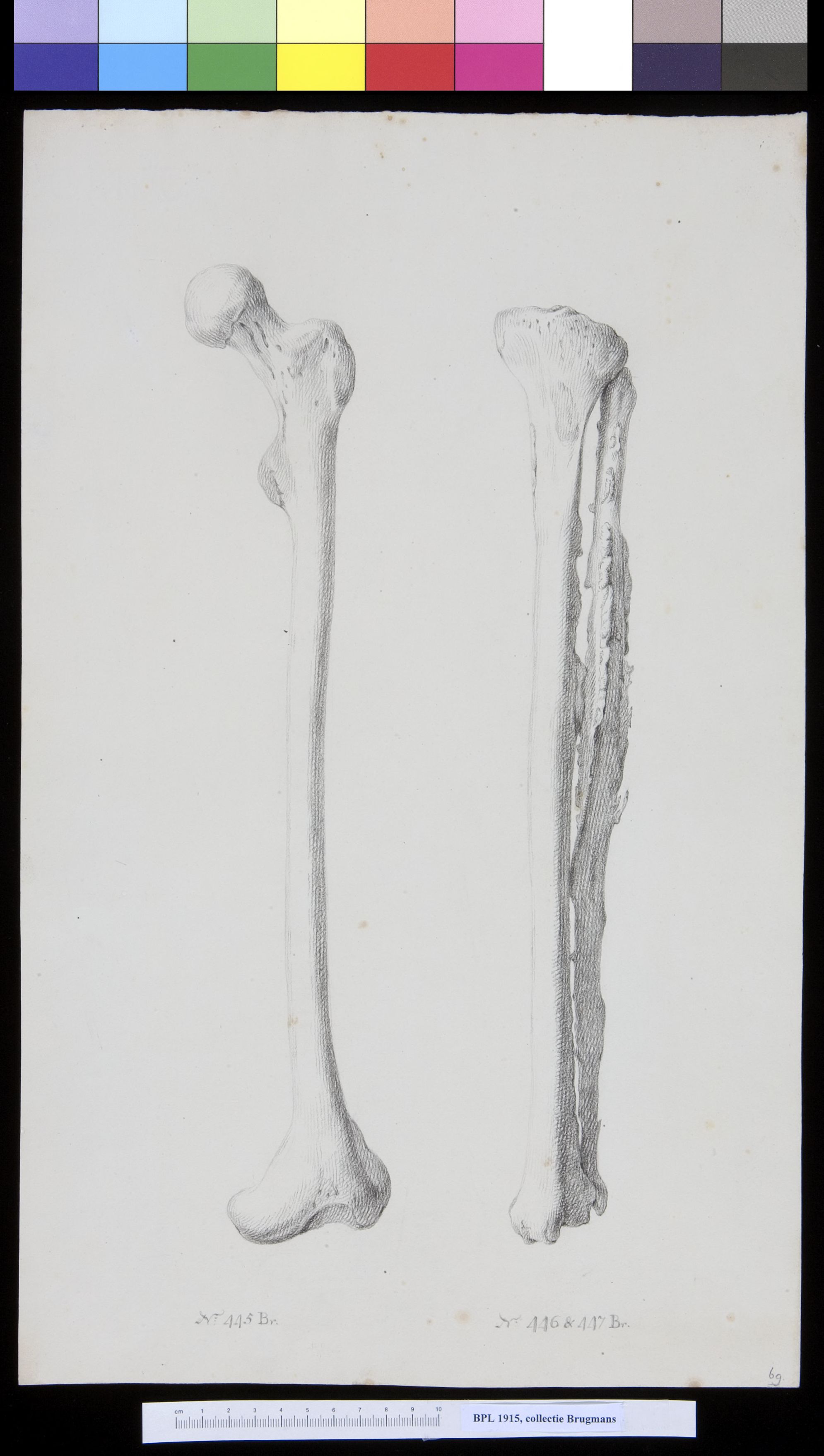 Bone of the leg (femur, tibia and fibula)
