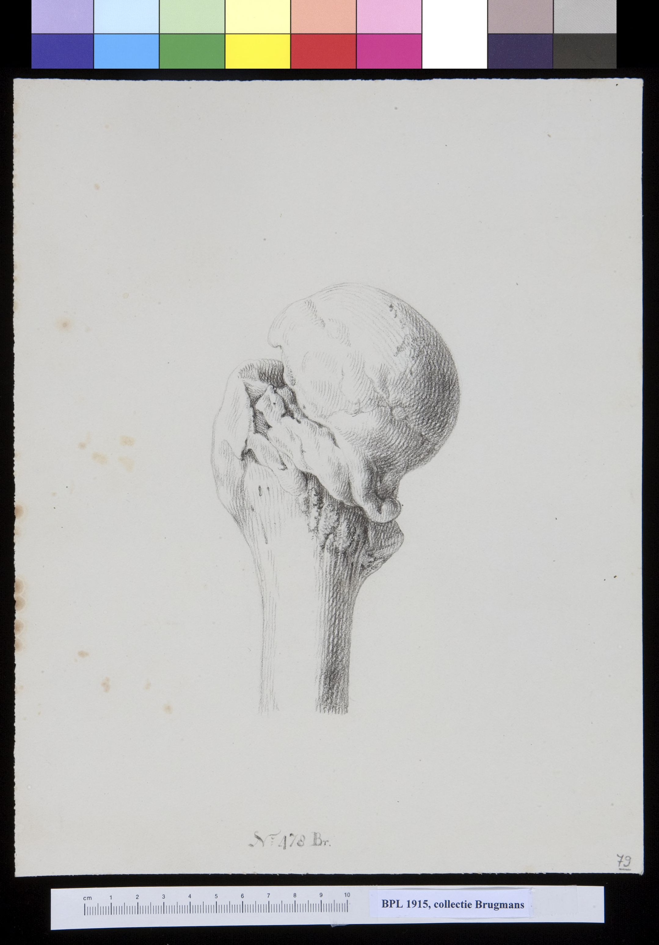 Bone of the upper leg (femur)