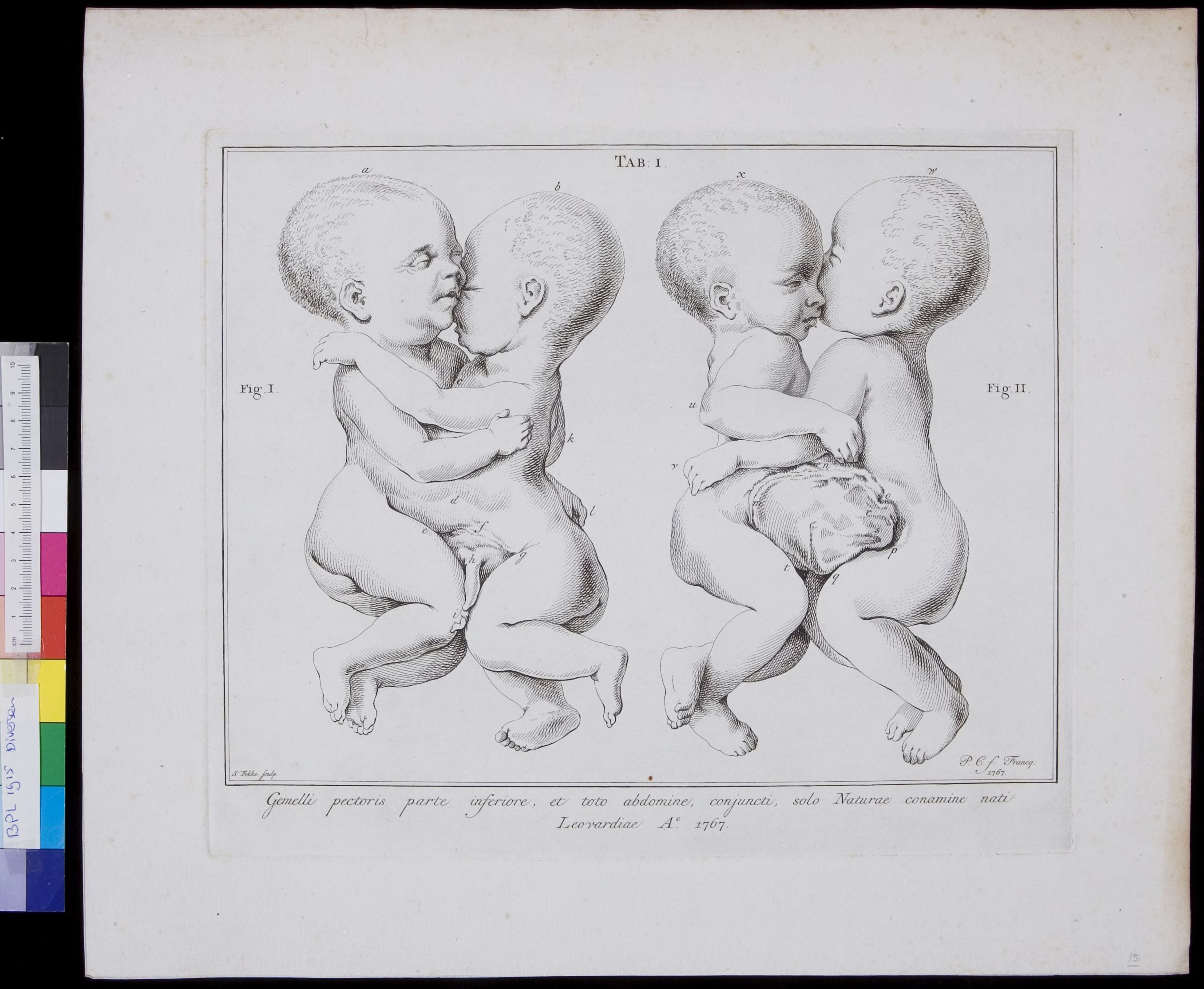 Conjoined twins