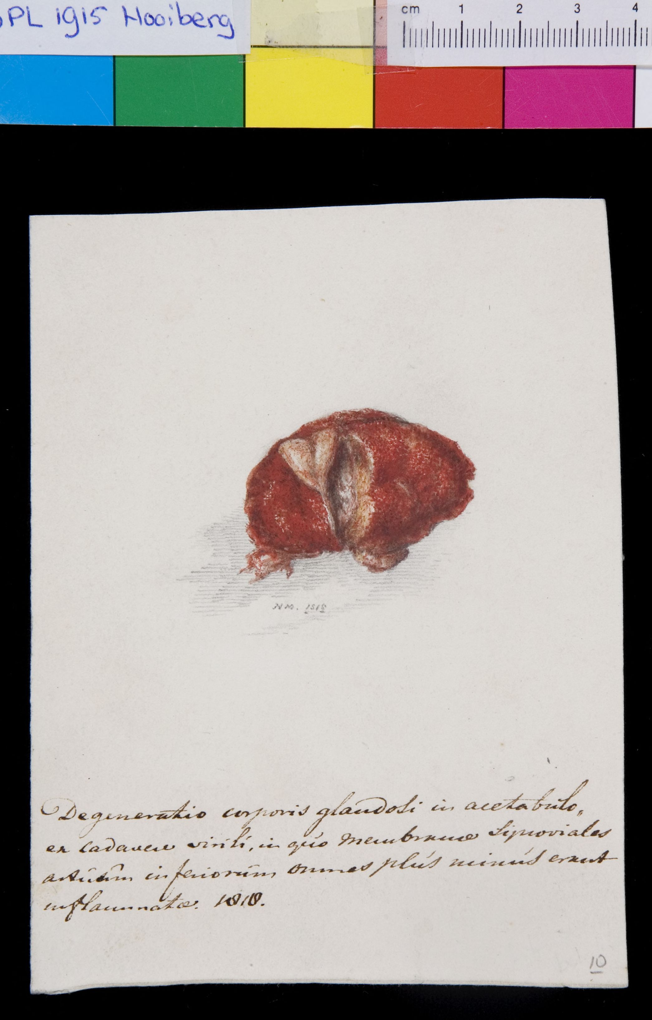 Pathology, acetabulum