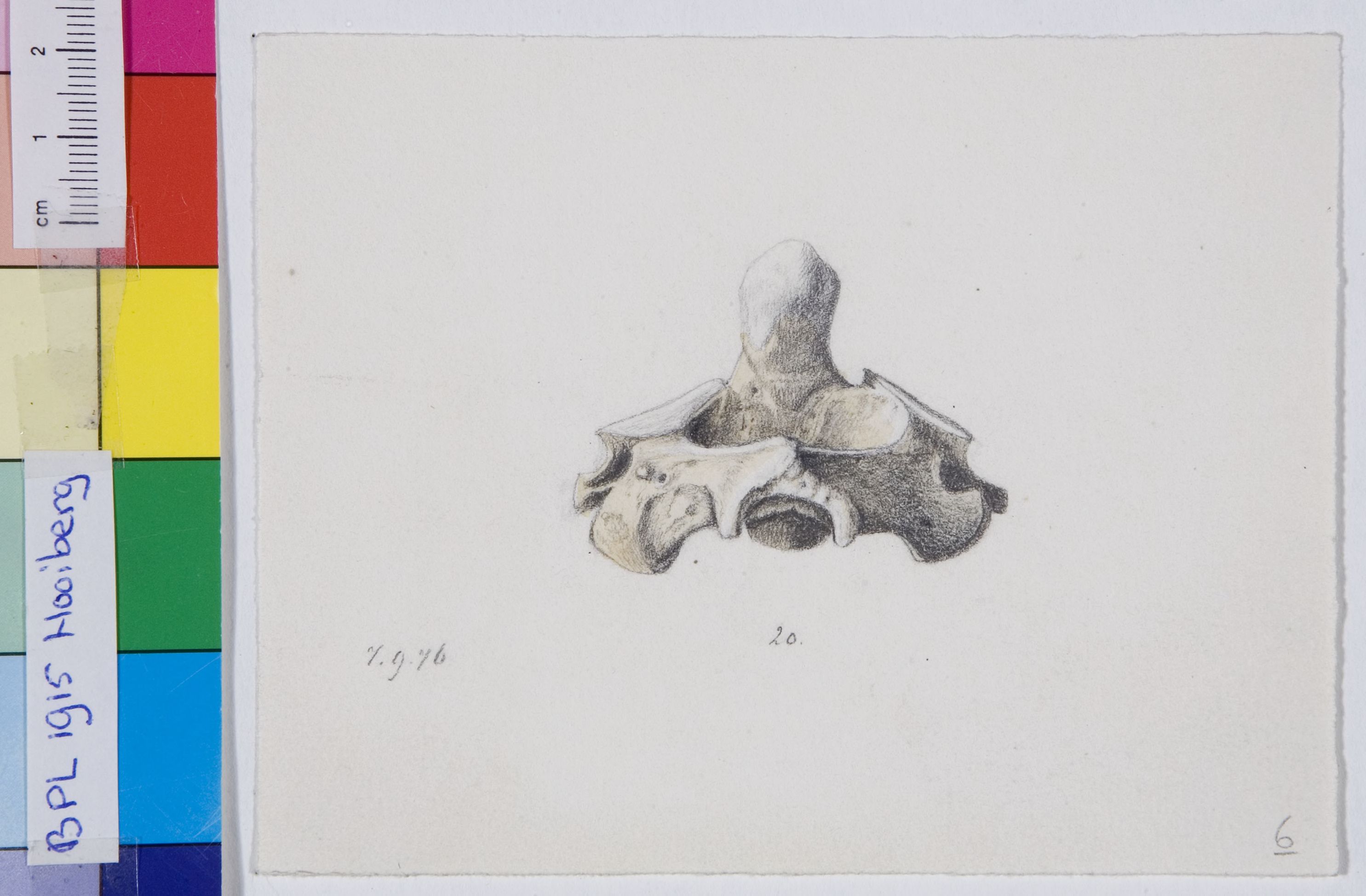 Pathology, vertebra