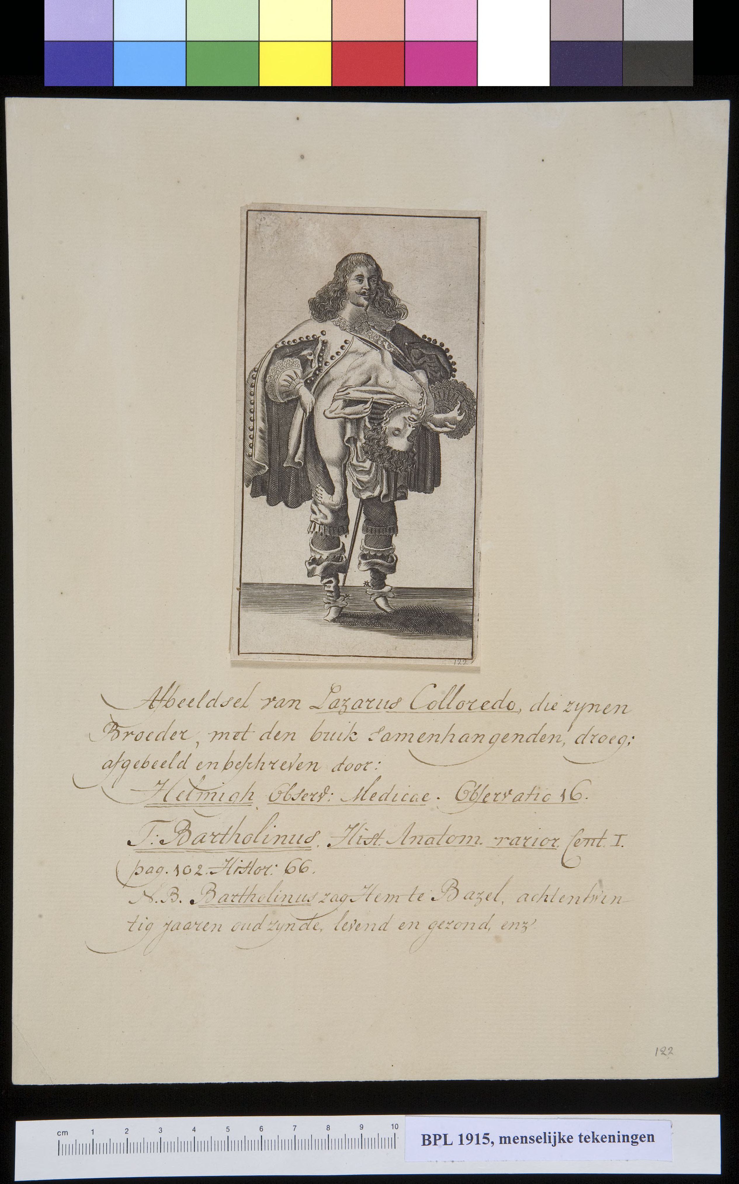 Conjoined twins: well dressed man carrying his brother