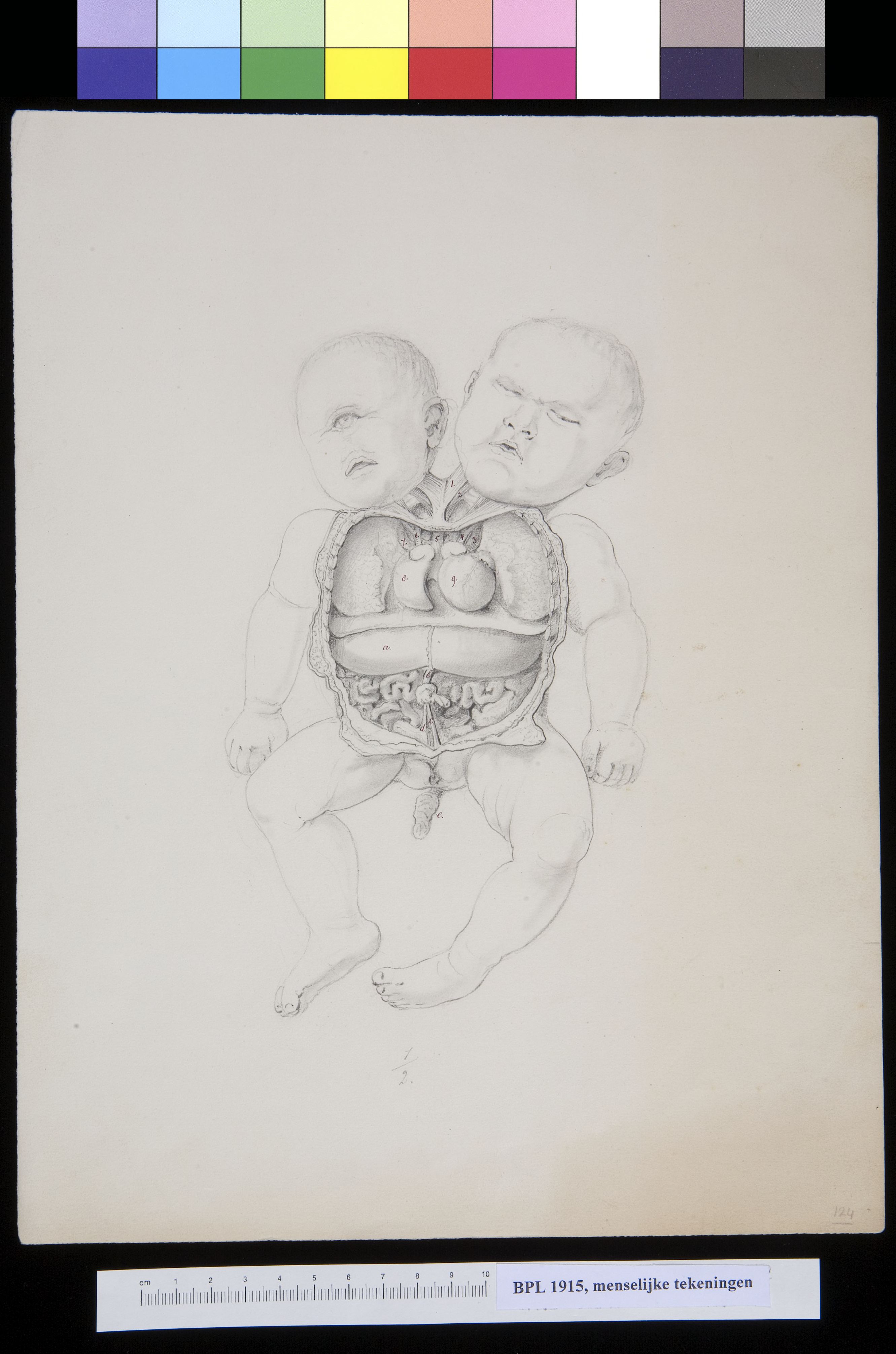 Conjoined twins