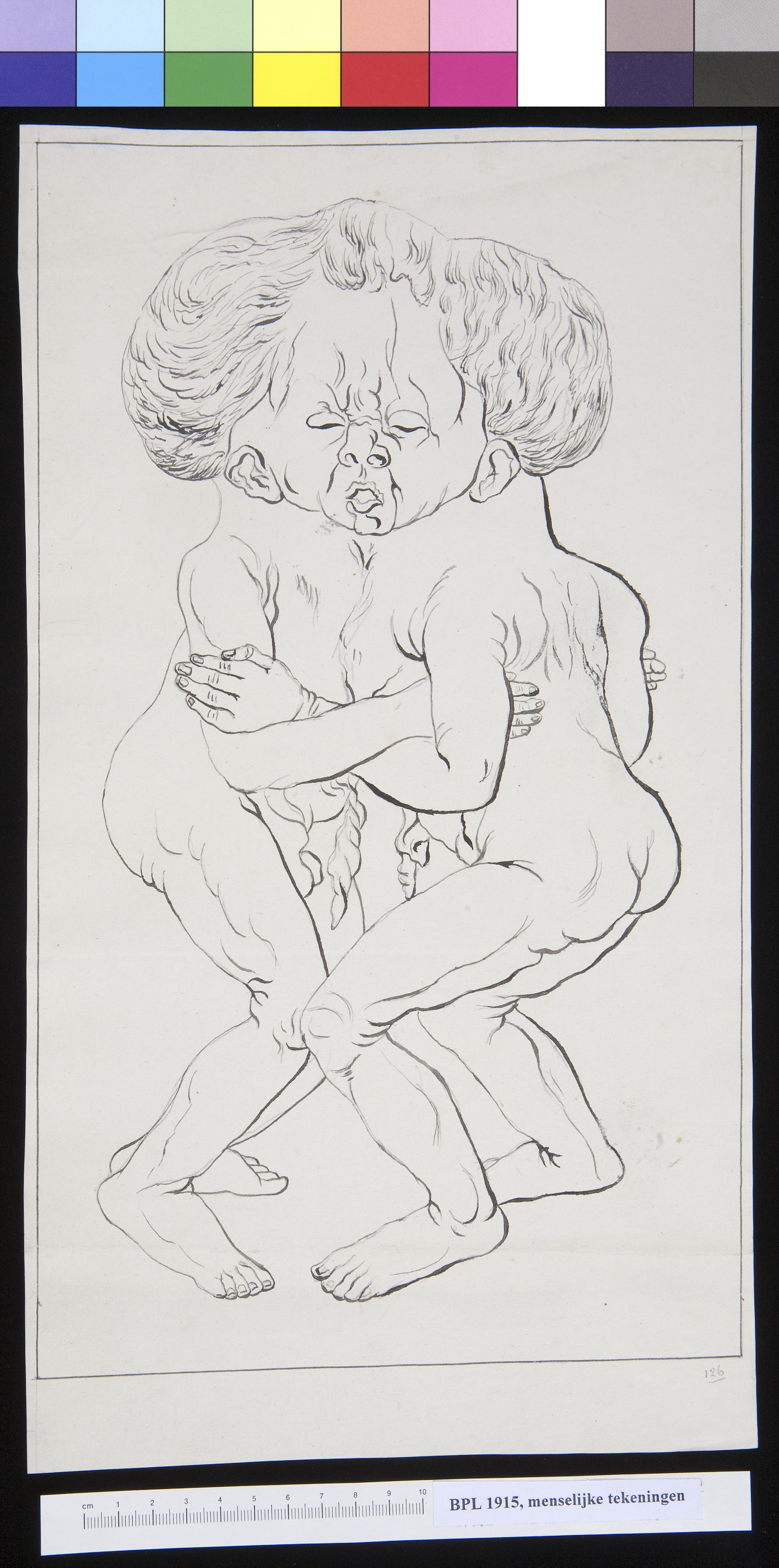 Conjoined twins