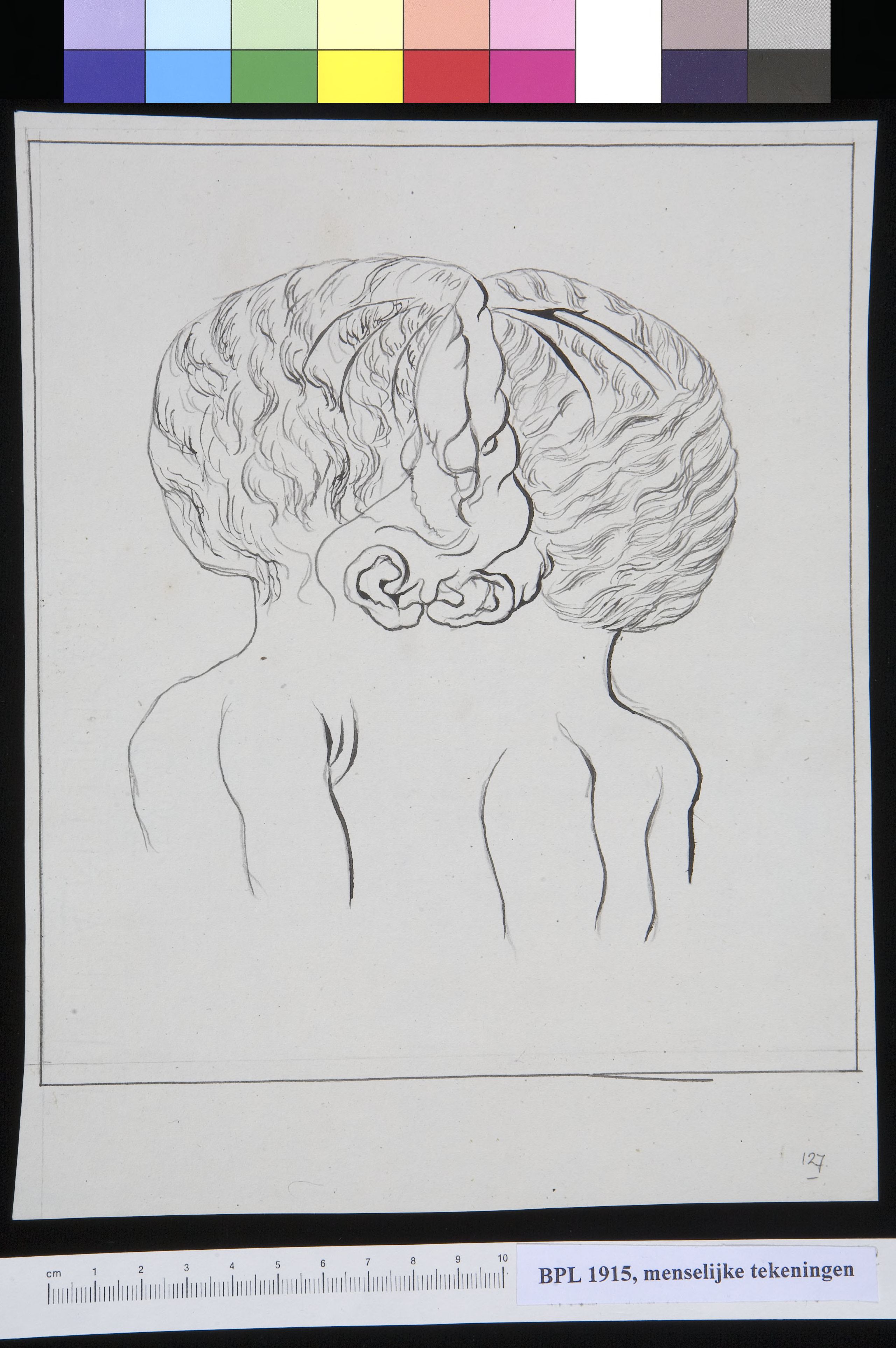 Conjoined twins