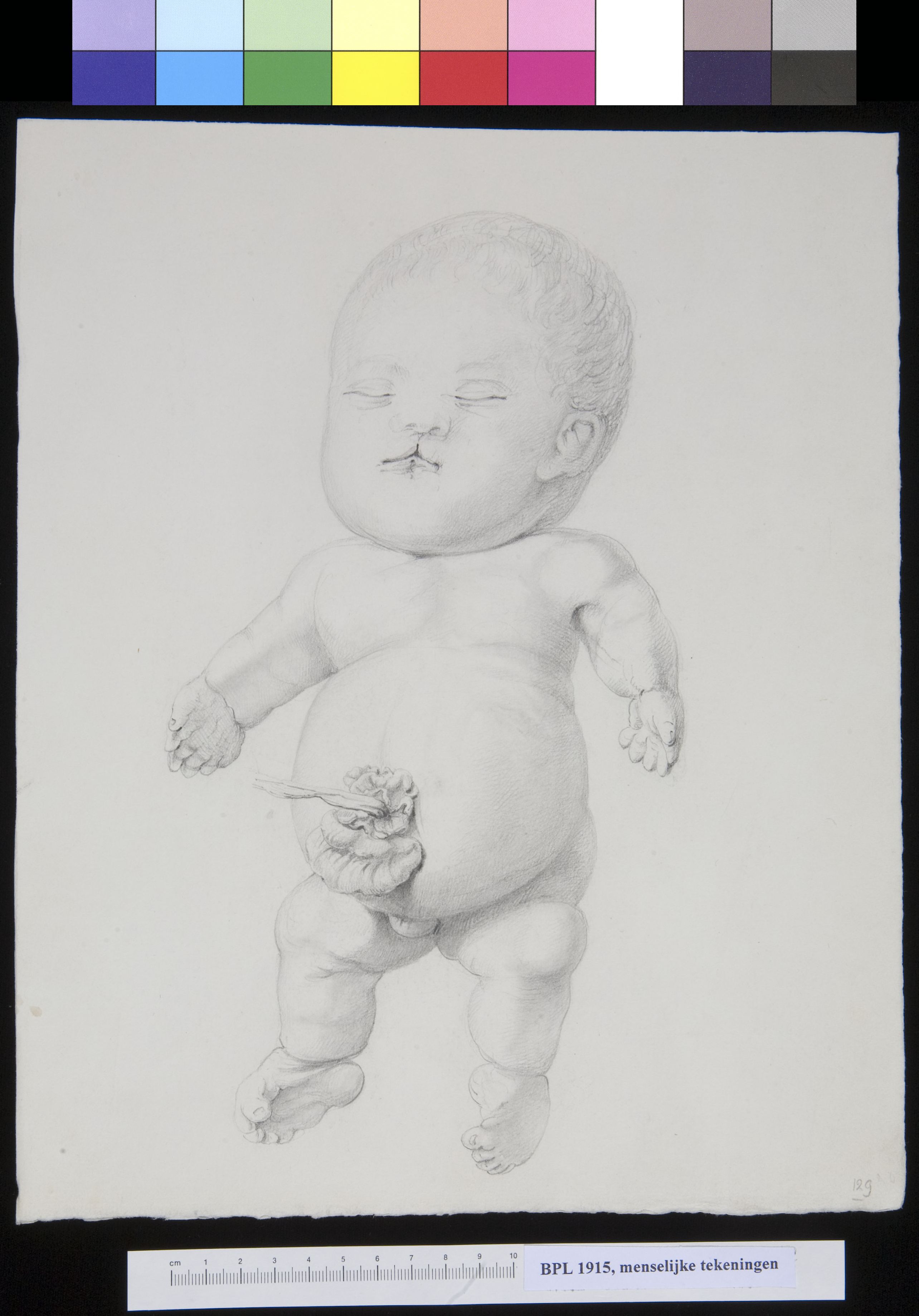 Baby with schisis (cleft lip)