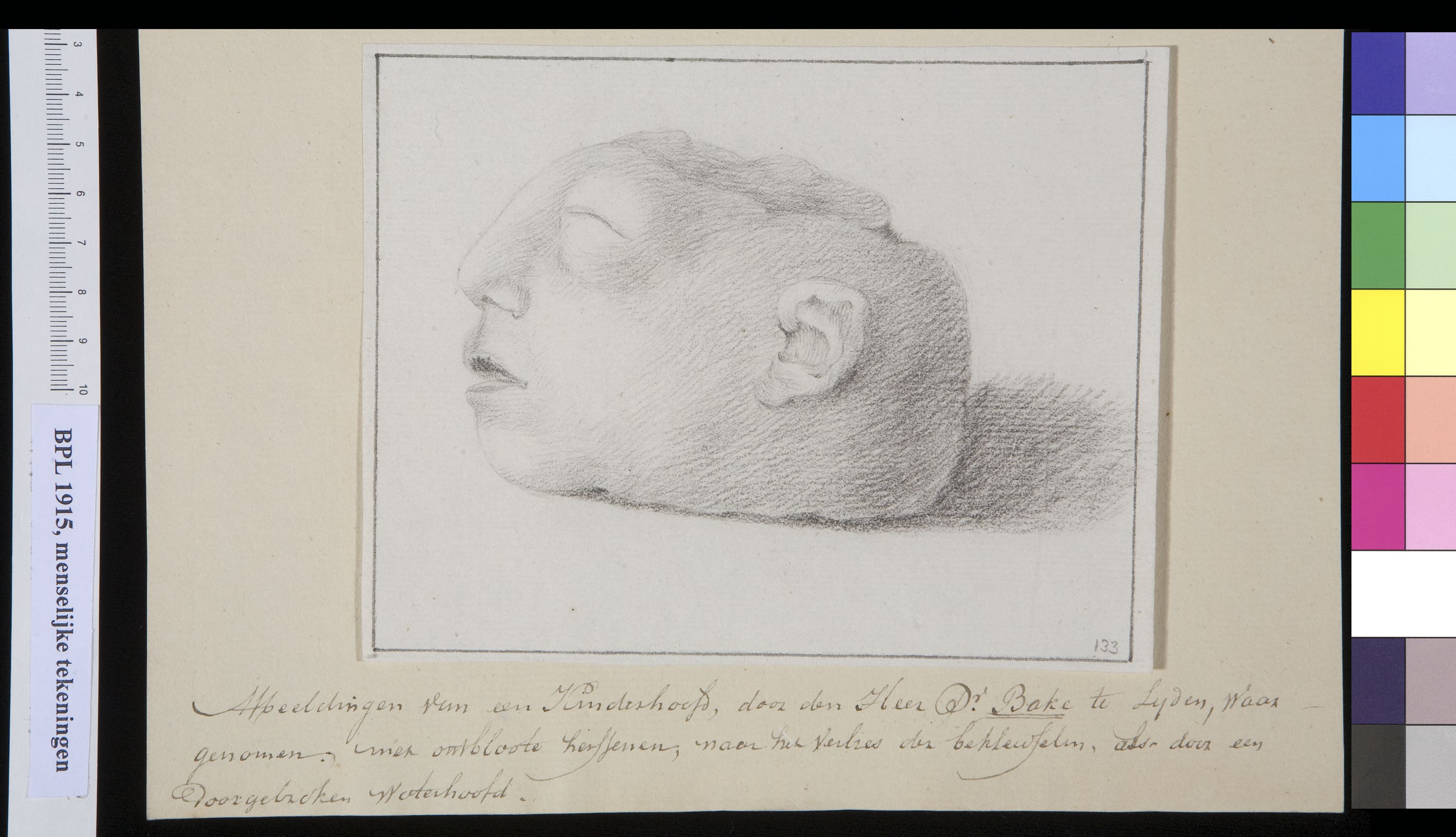 Hydrocephalus