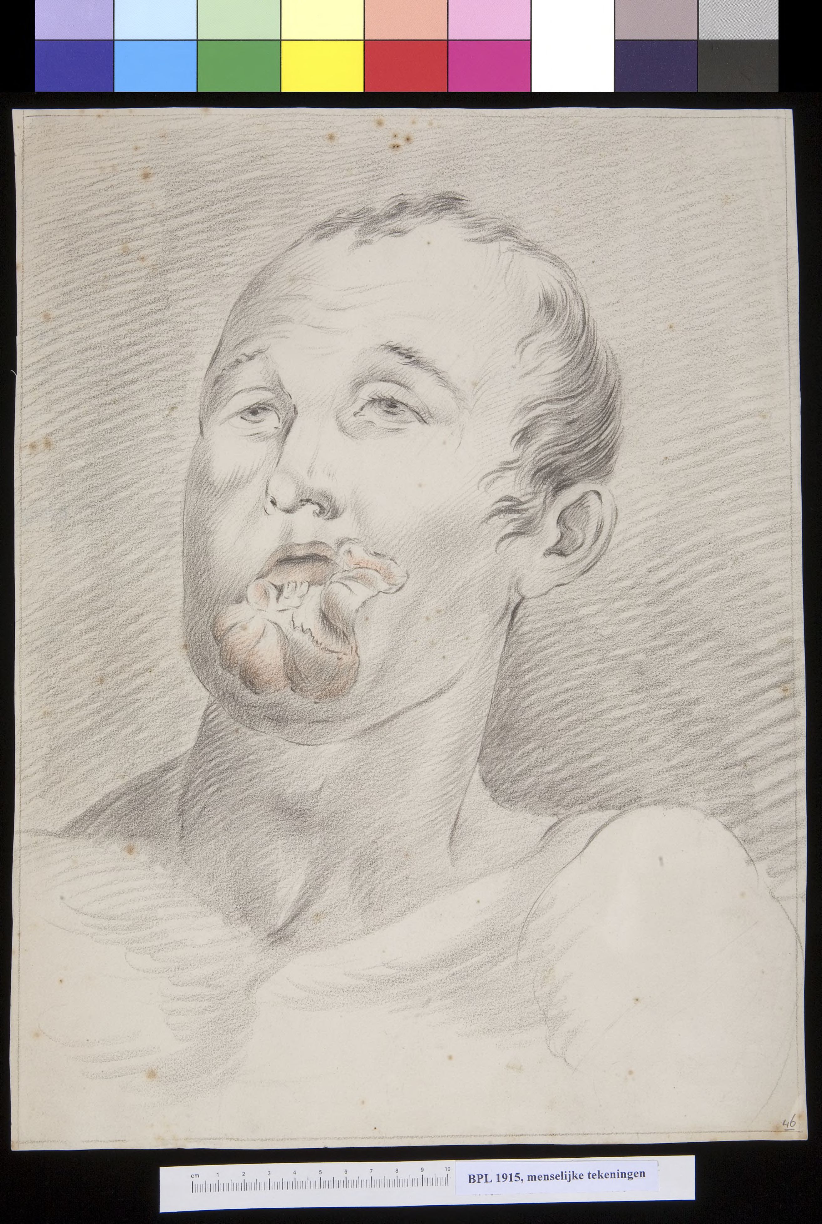 Tumor of the lower lip
