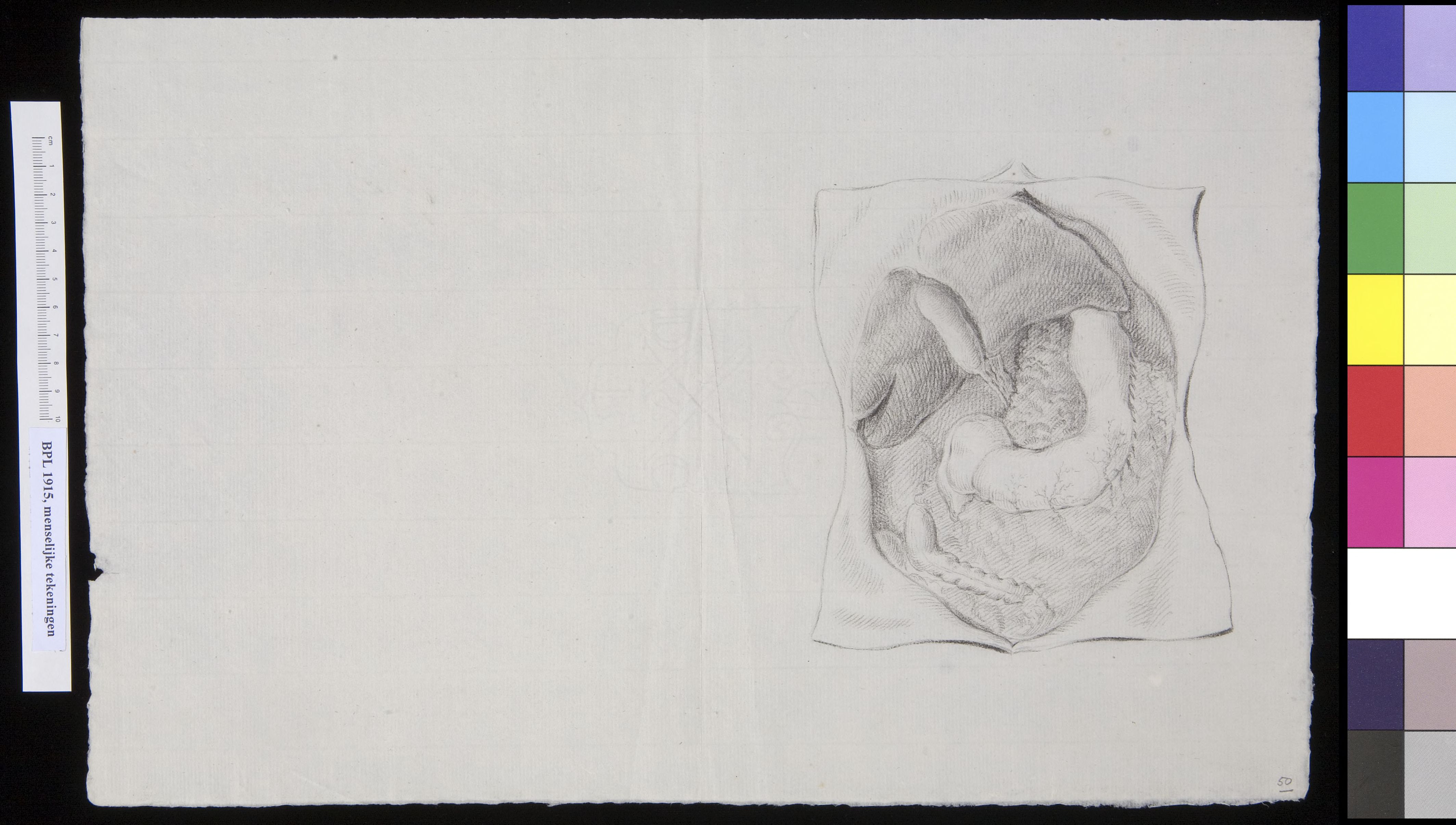 Open abdomen