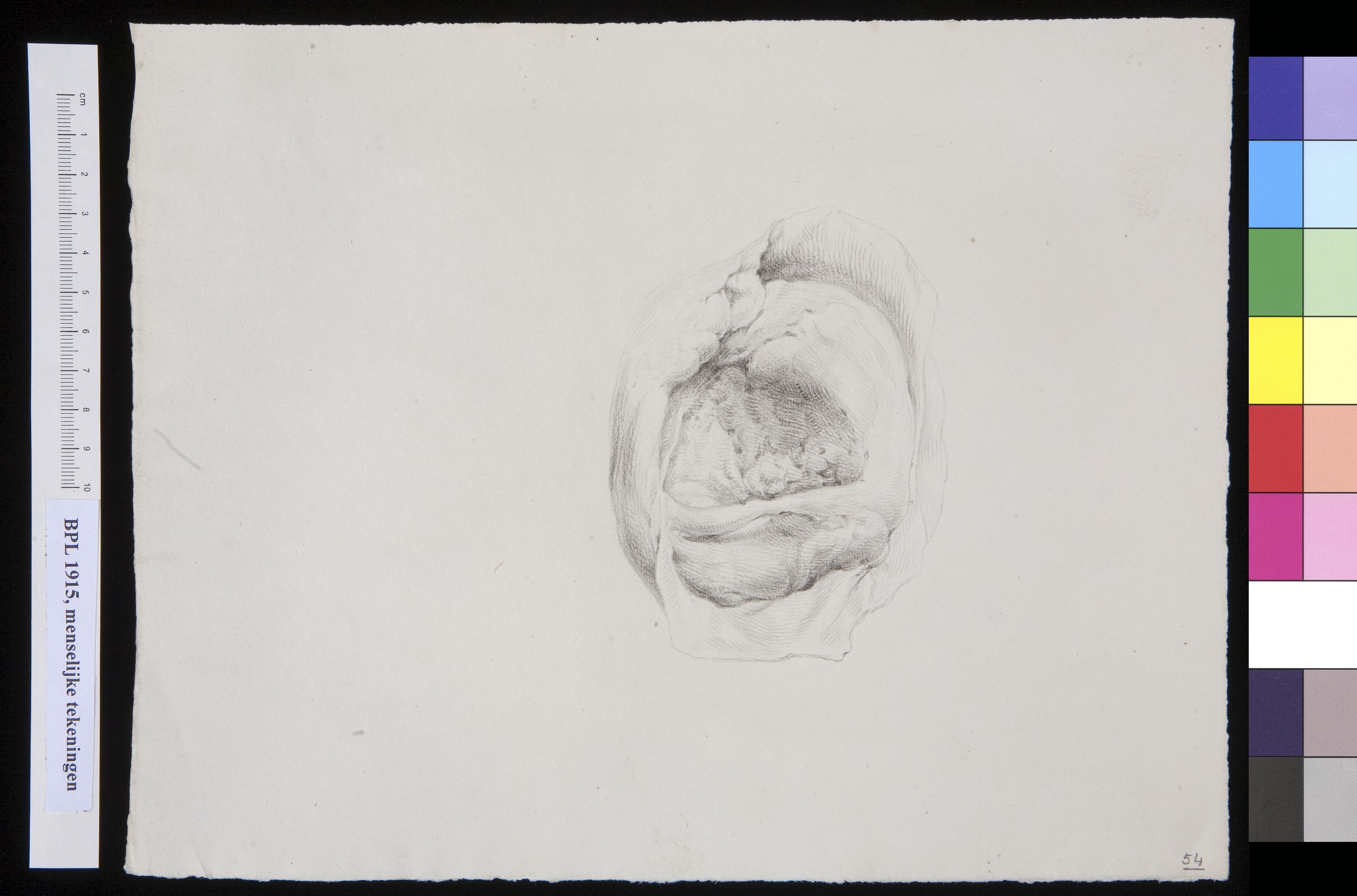 Tumor of the uterus