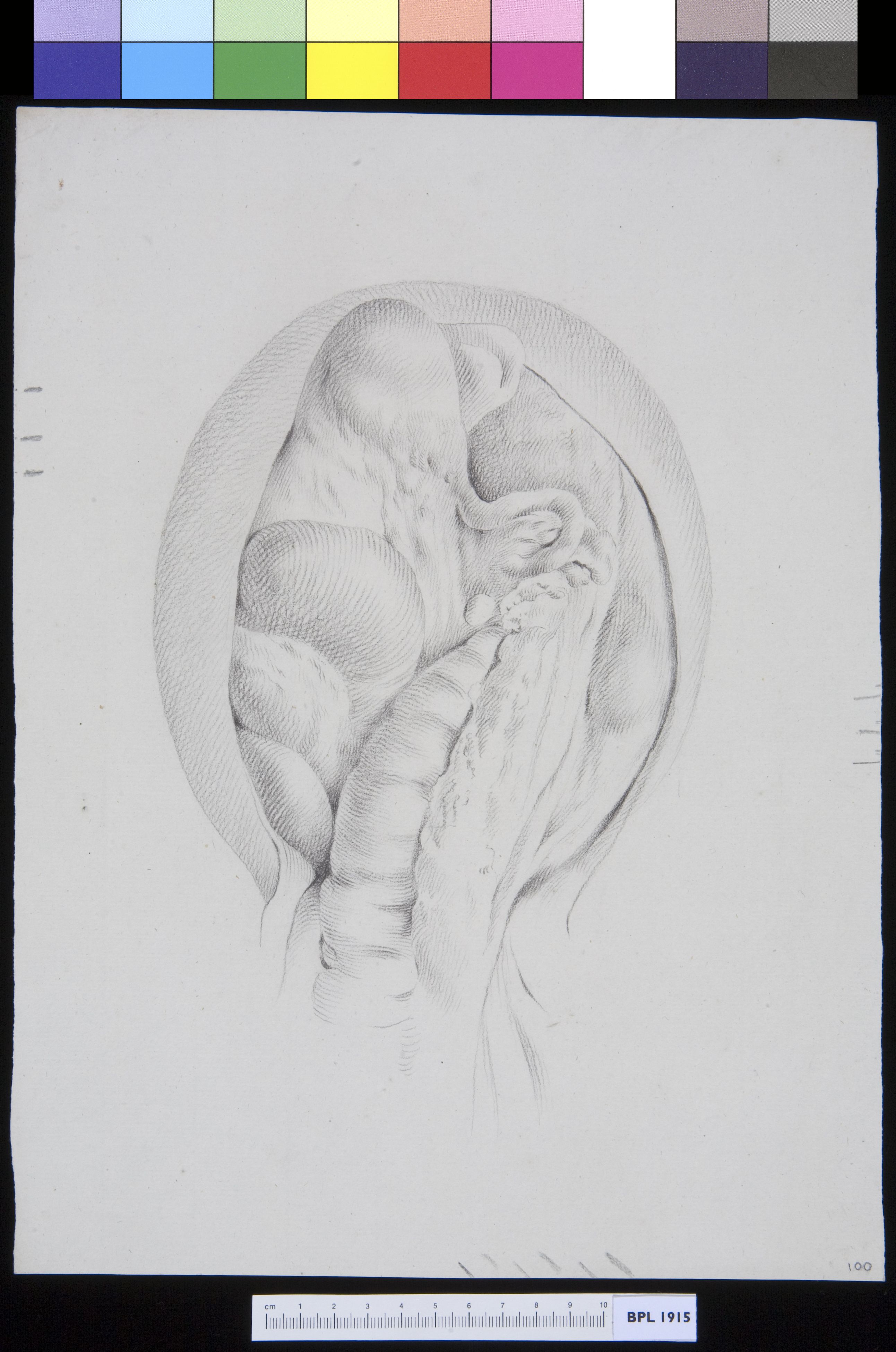 Inguinal hernia