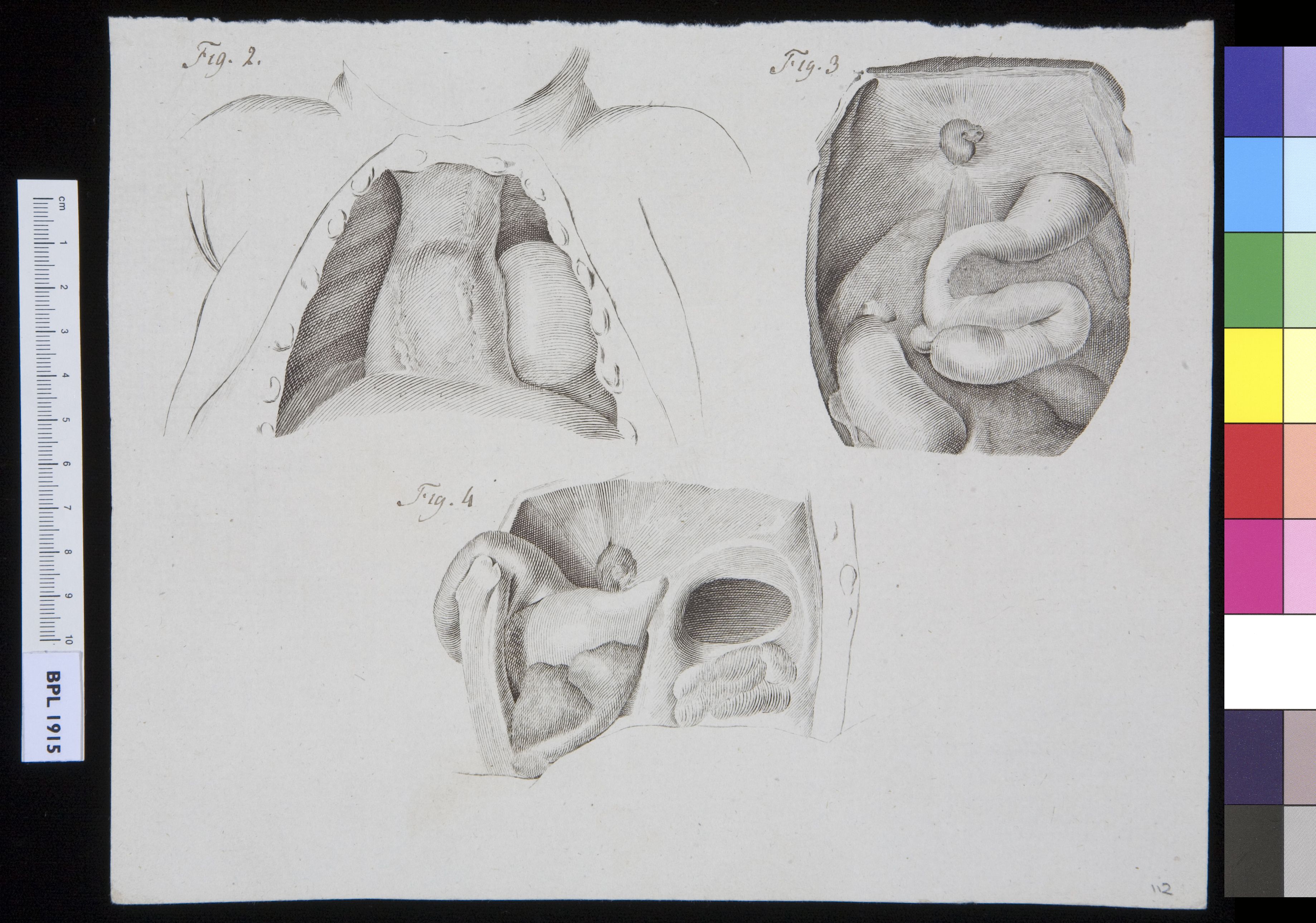 Three views of an aneurysm