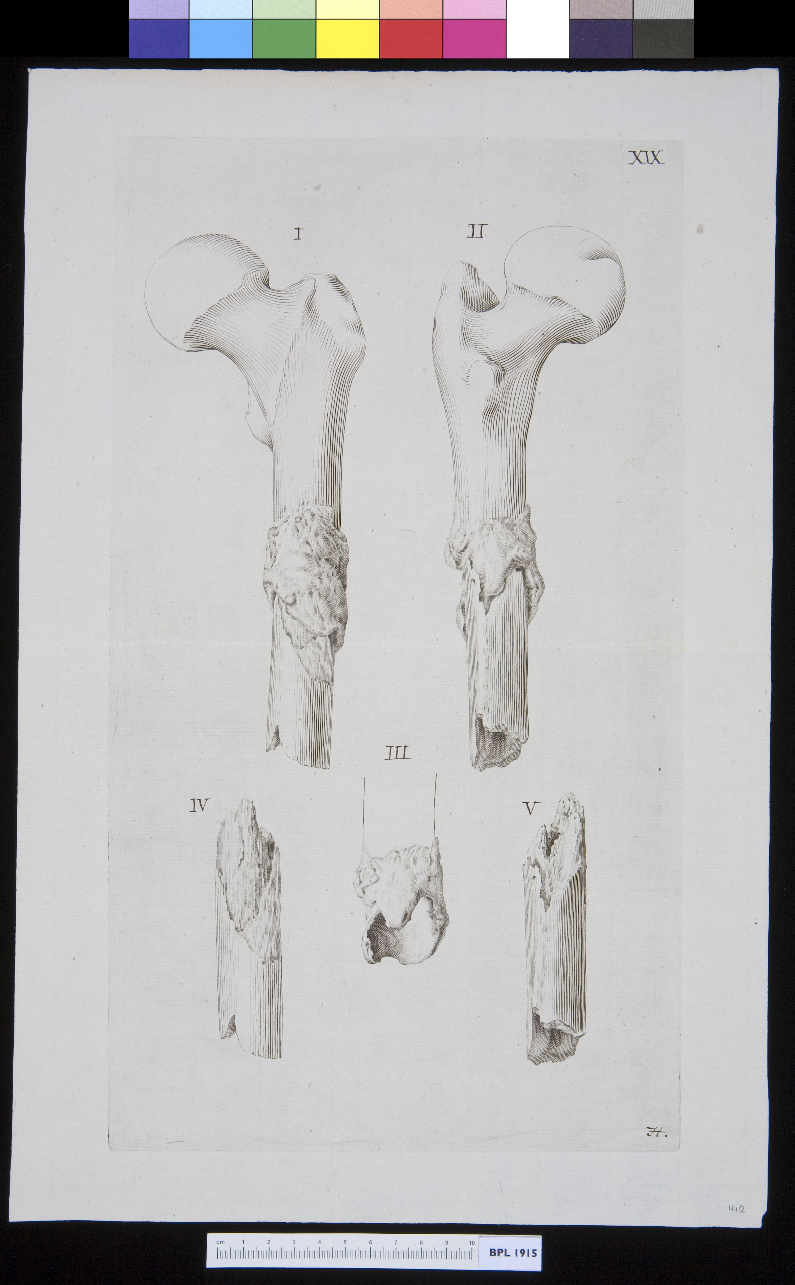 Infected bones (femur)