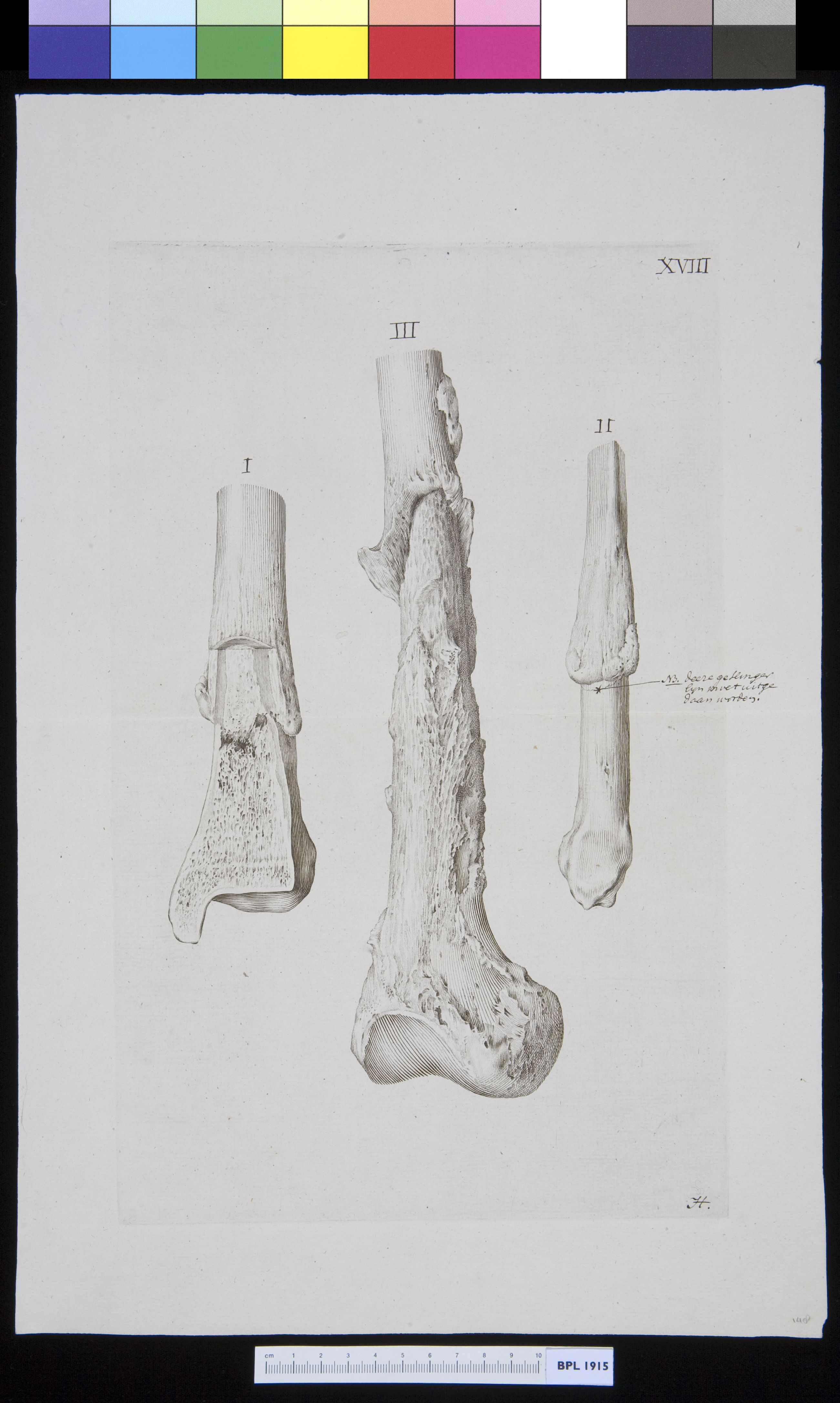 Infected bone (tibia?)