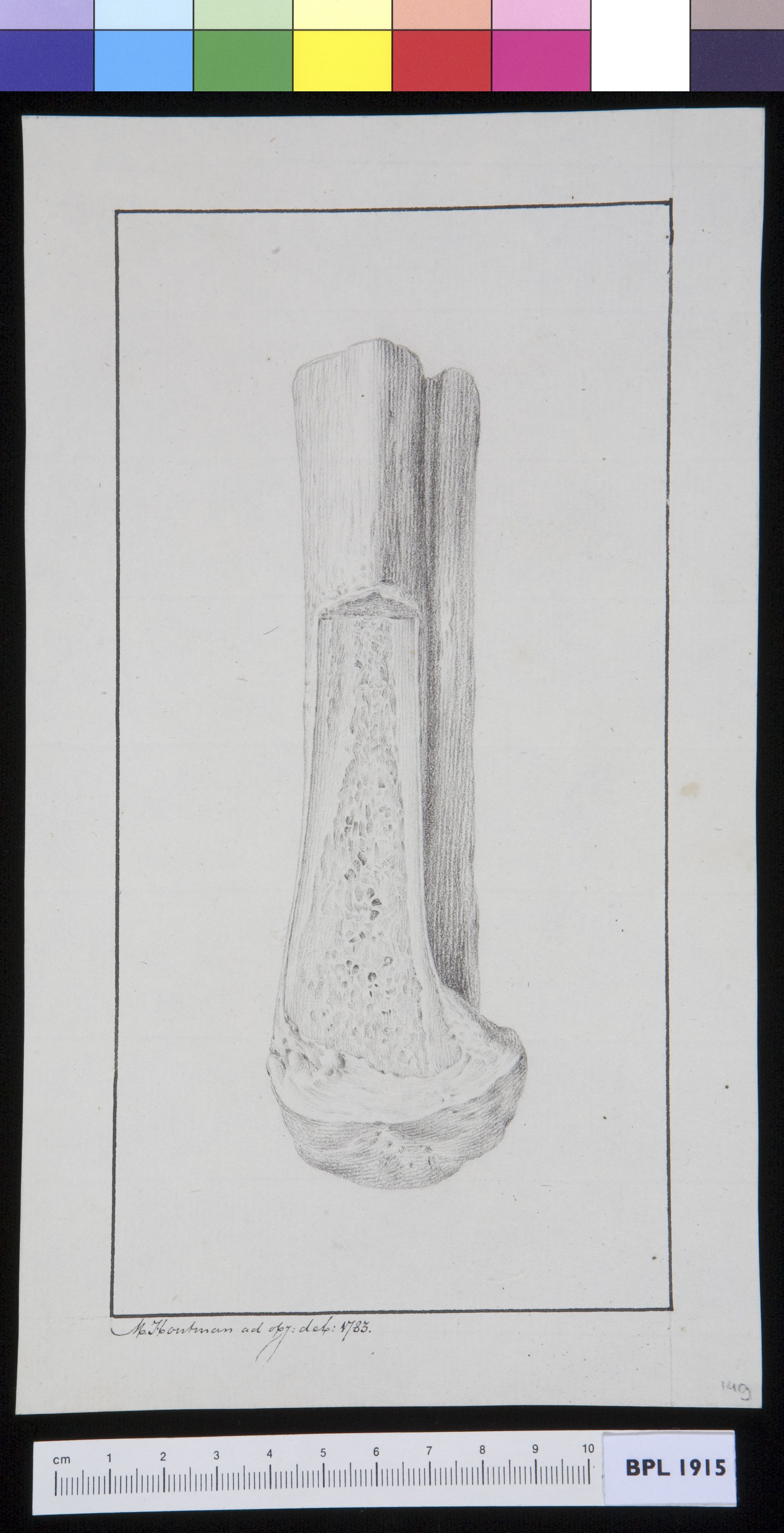 Infected bone (tibia?)