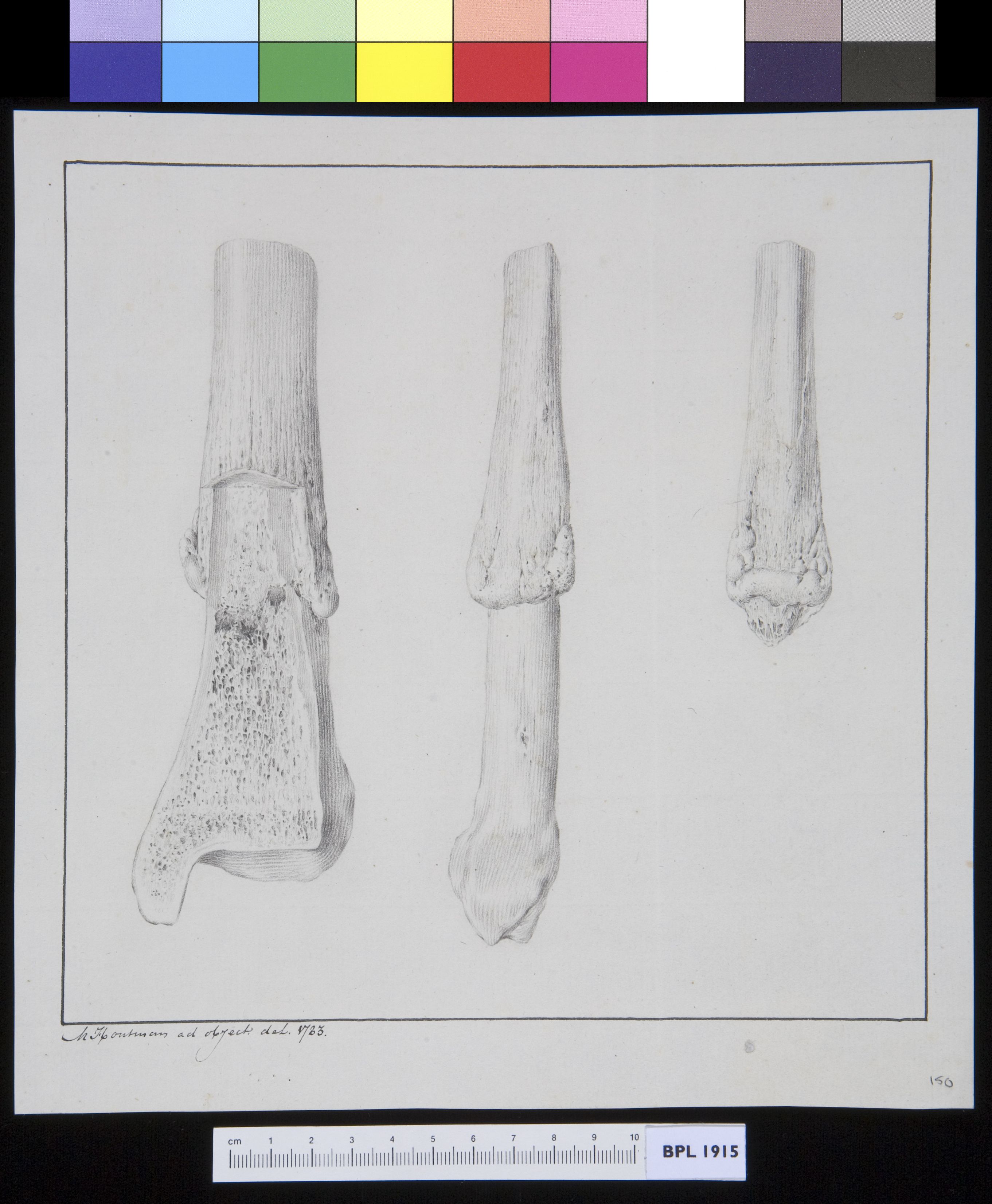 Infected bone (tibia?)