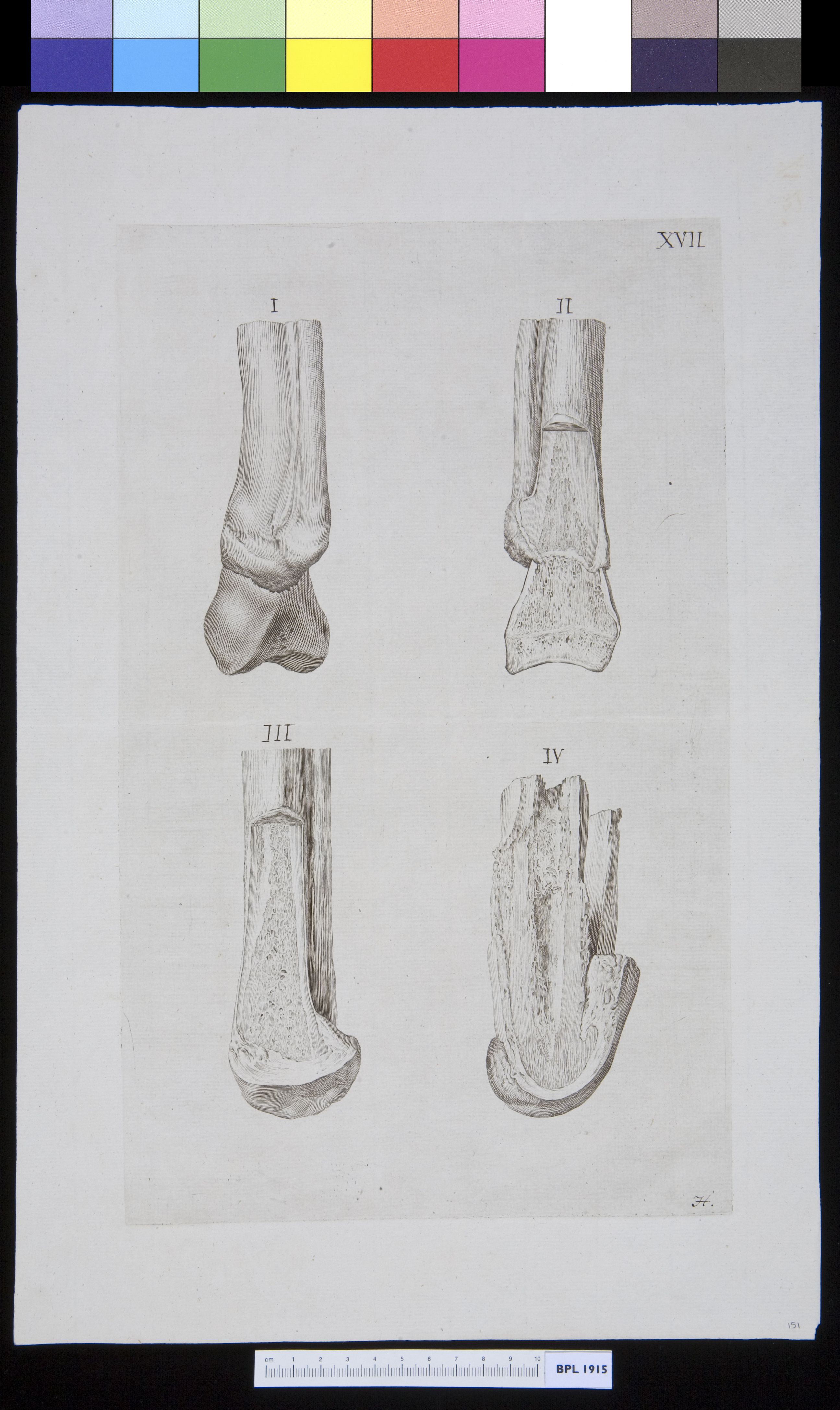 Infected bone (tibia?)