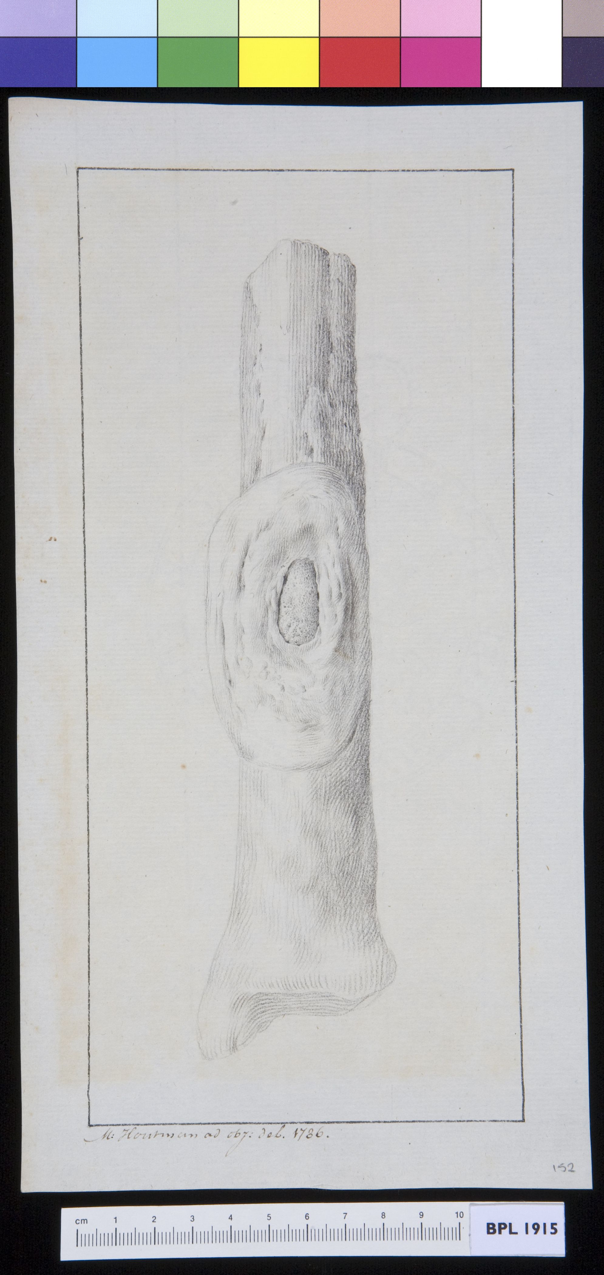 Infected bone (tibia?)