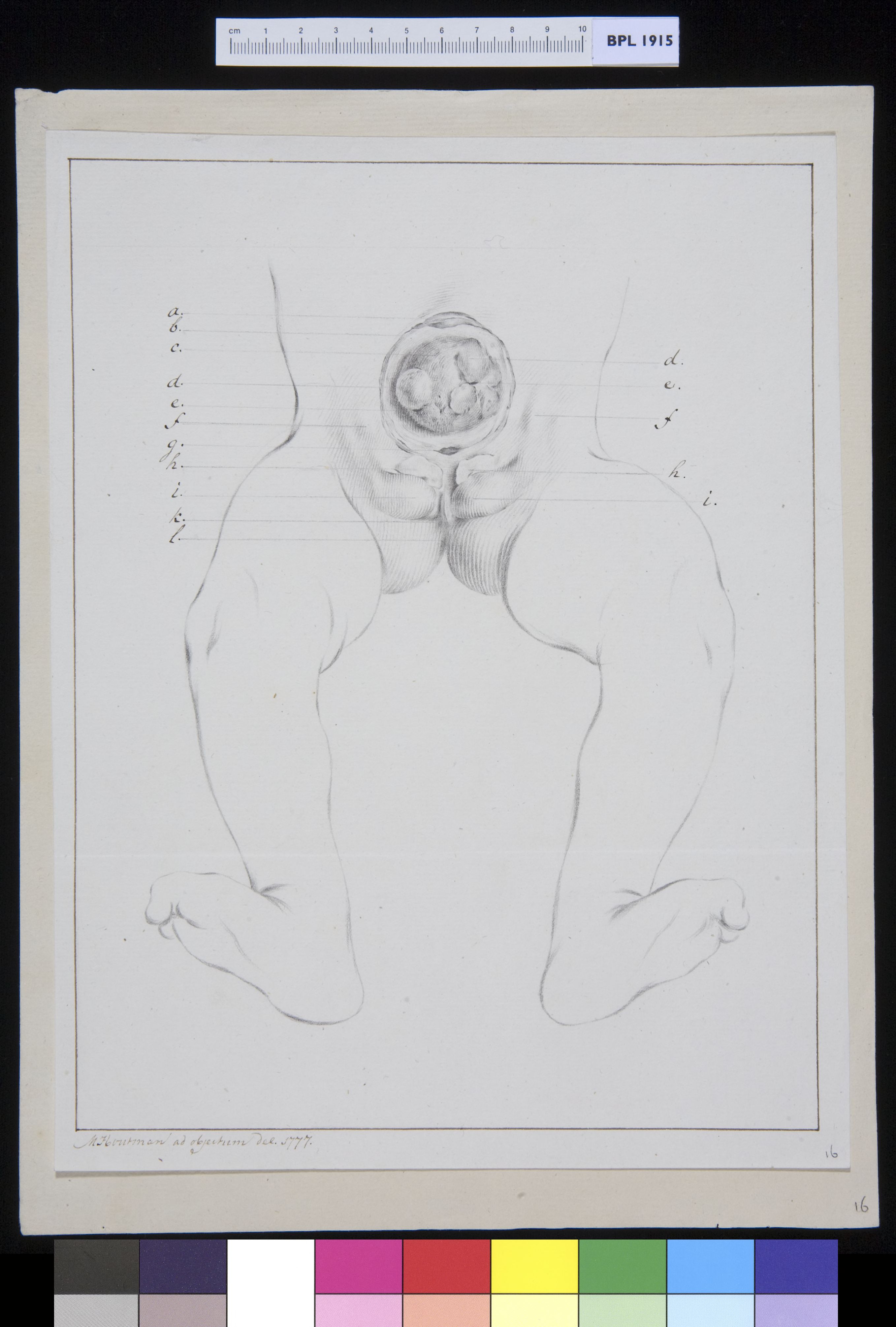 Intestines and genitals of a child, umbilical tumor