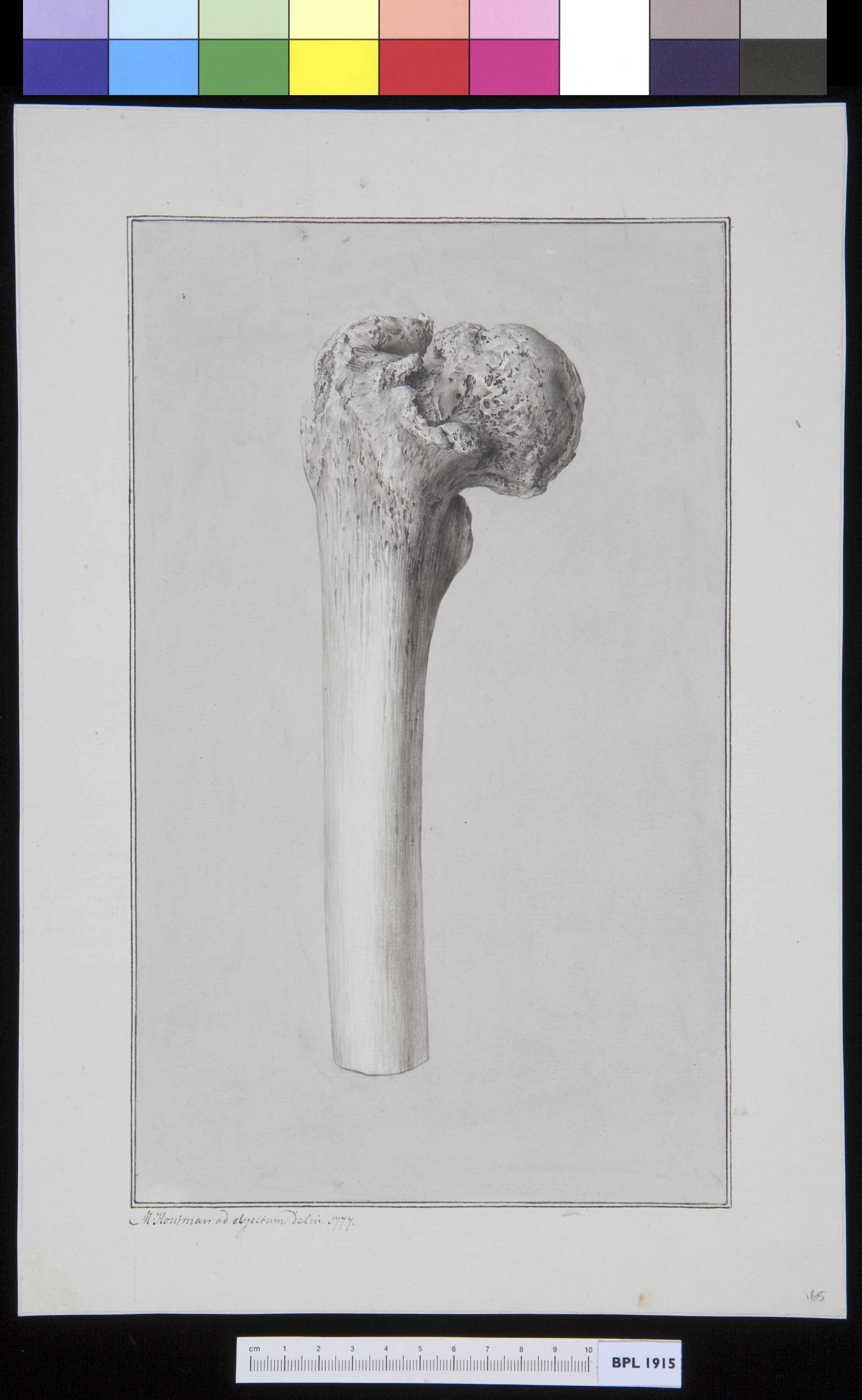 Infected bone (femur)