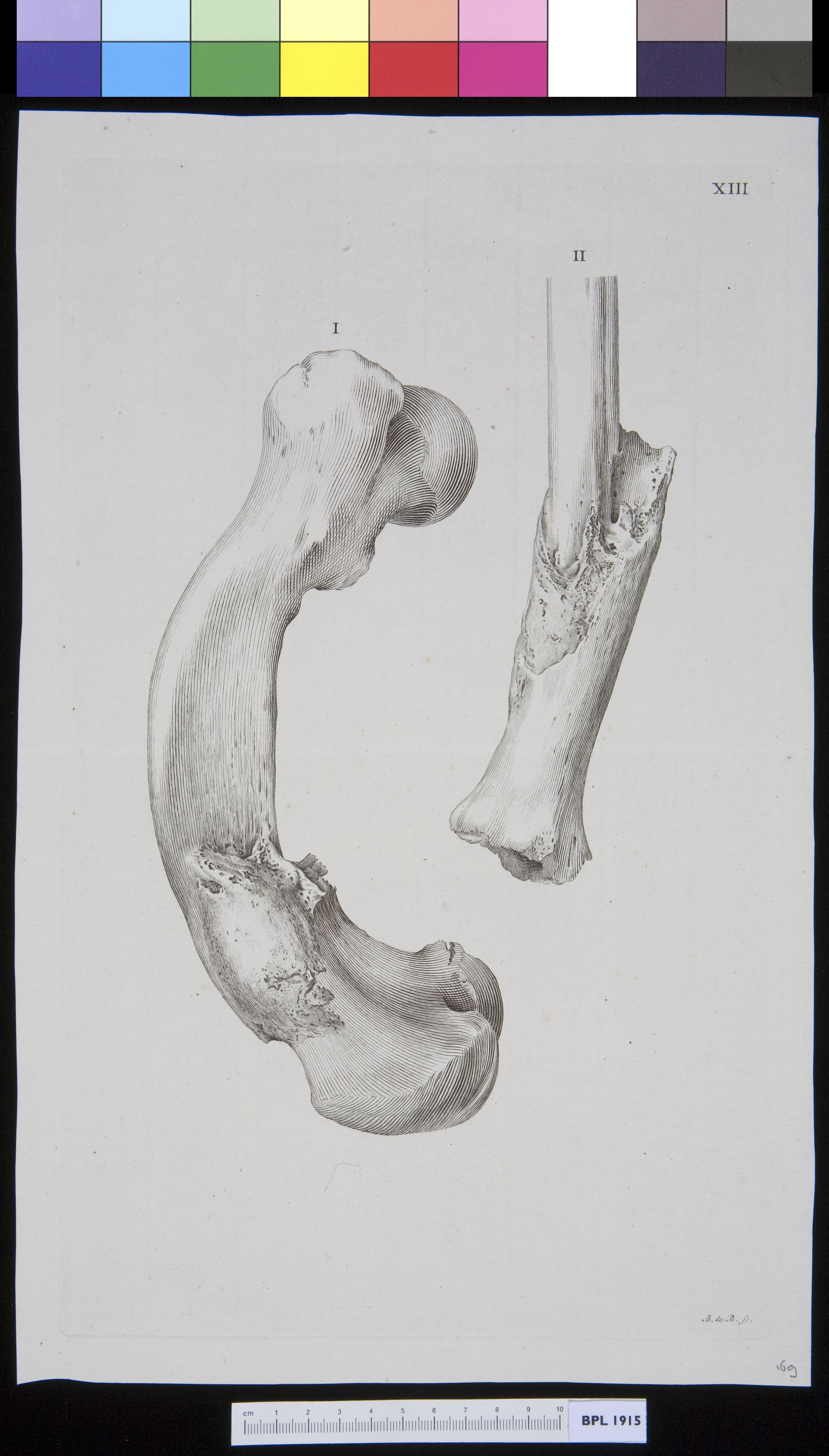 Infected bone (femur)