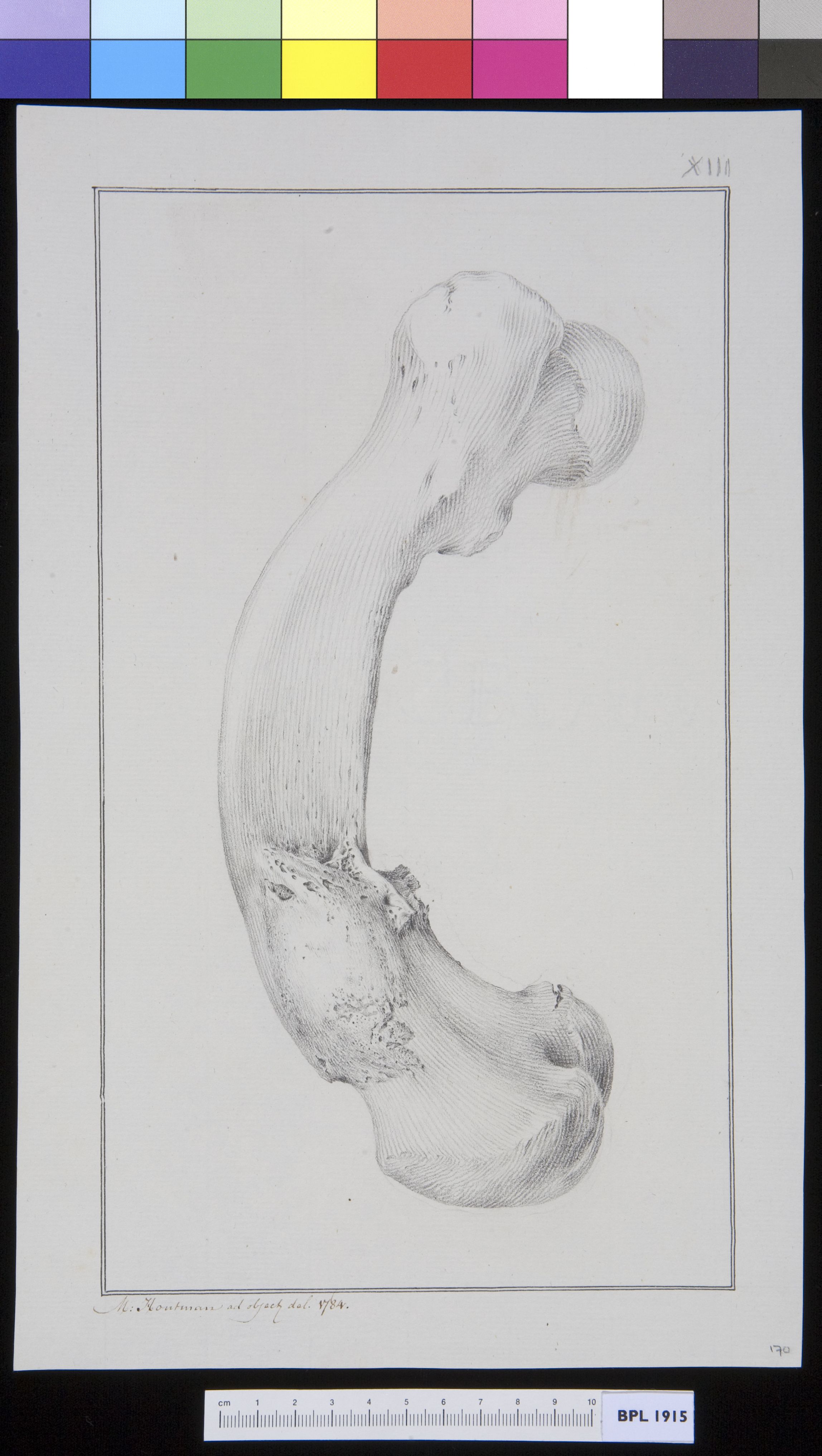 Infected bone (femur?)