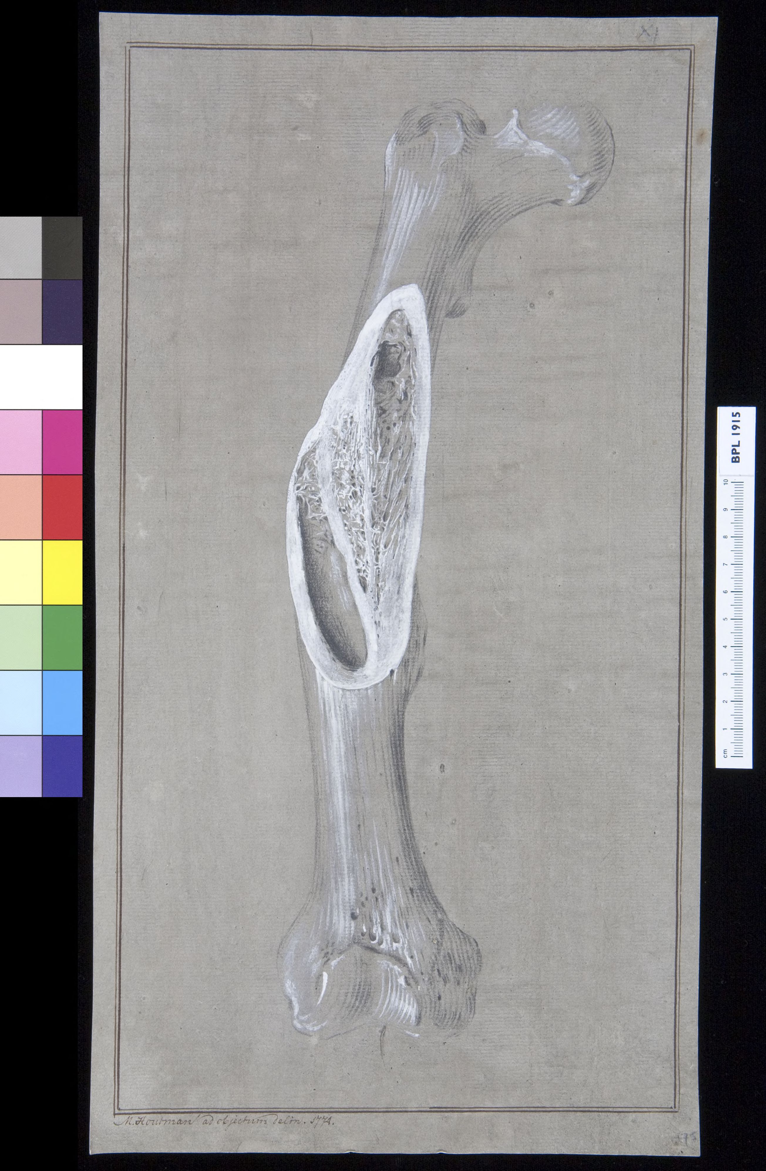 Infected bone