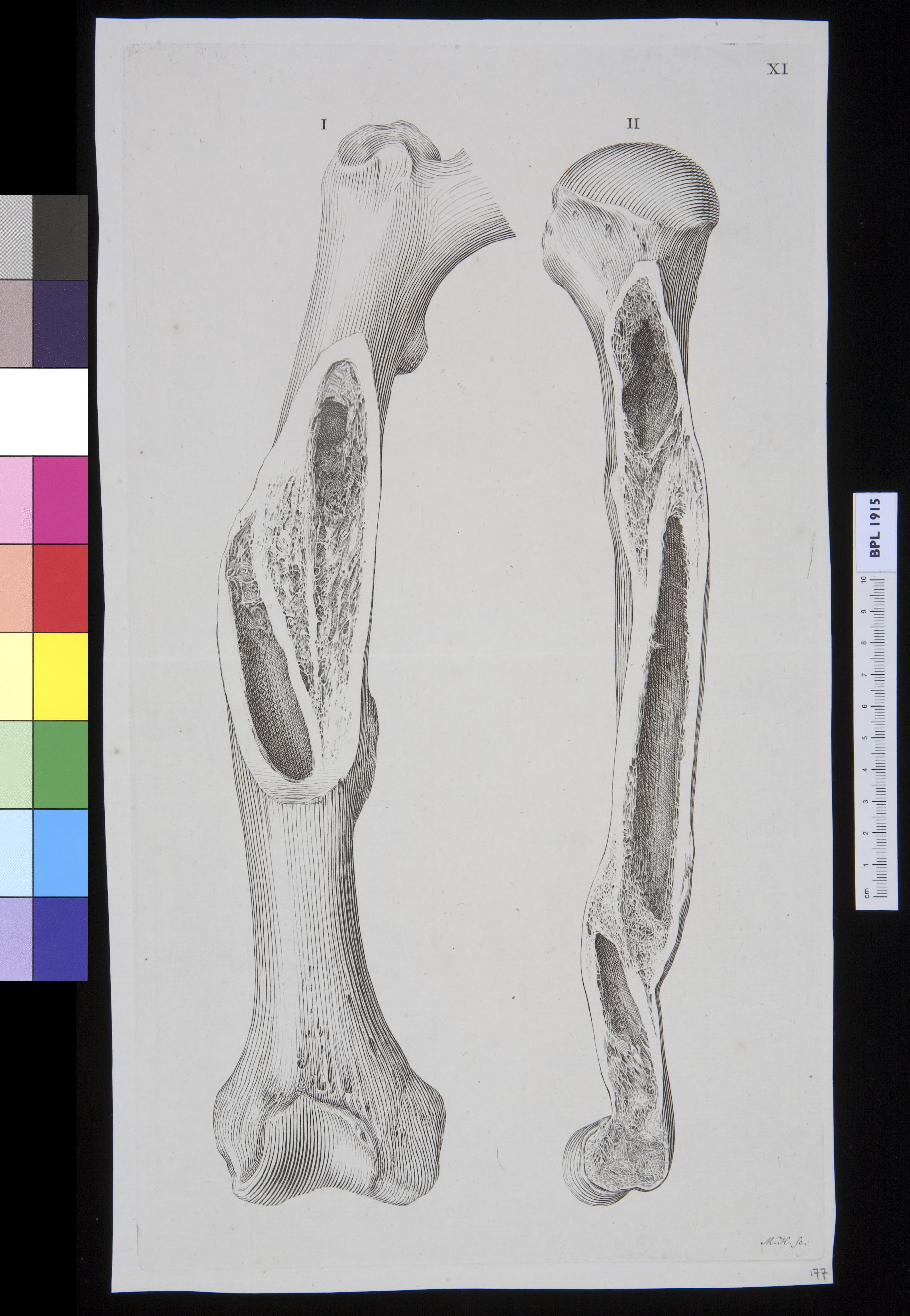 Infected bone (femur?)