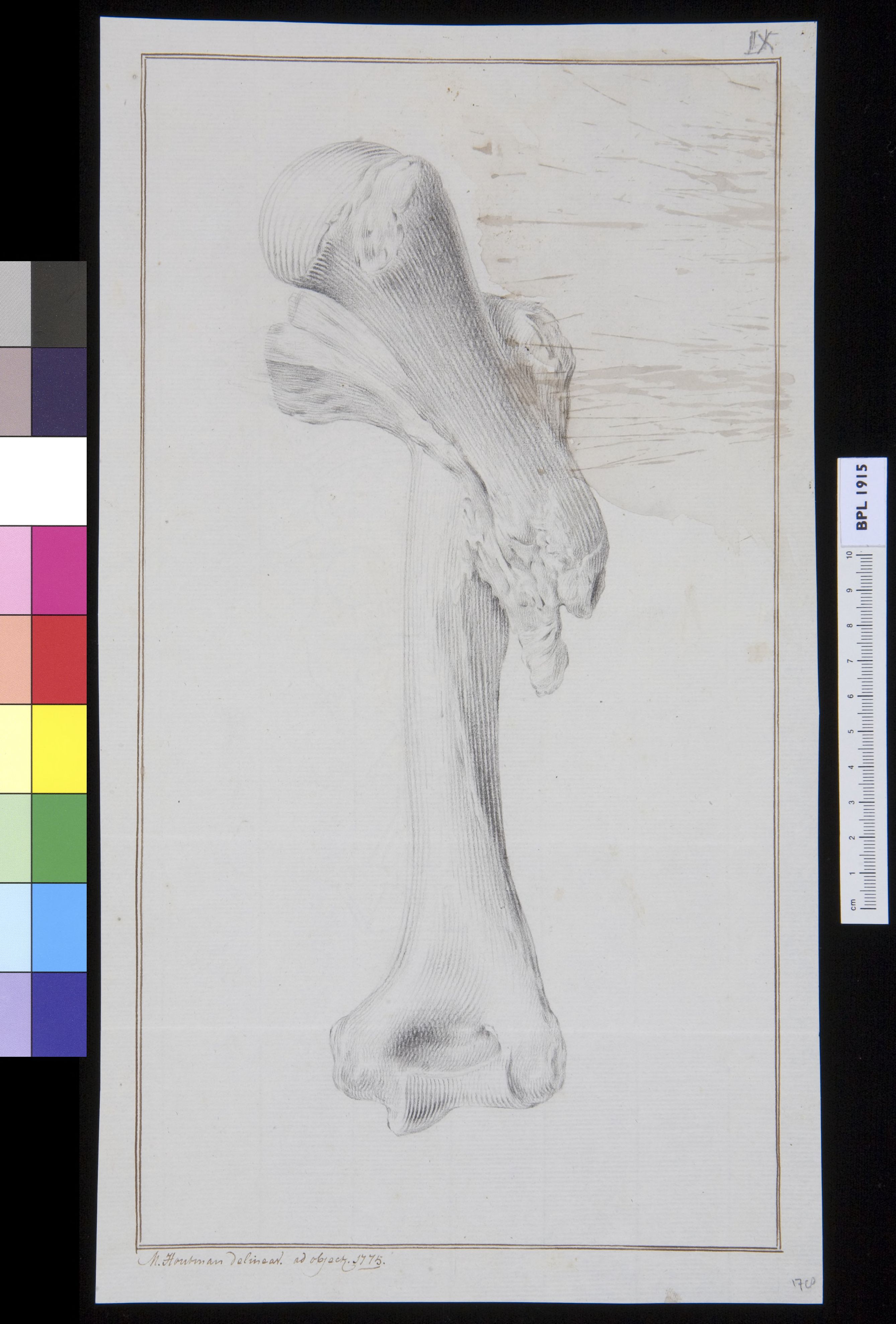 Infected bone (femur?)