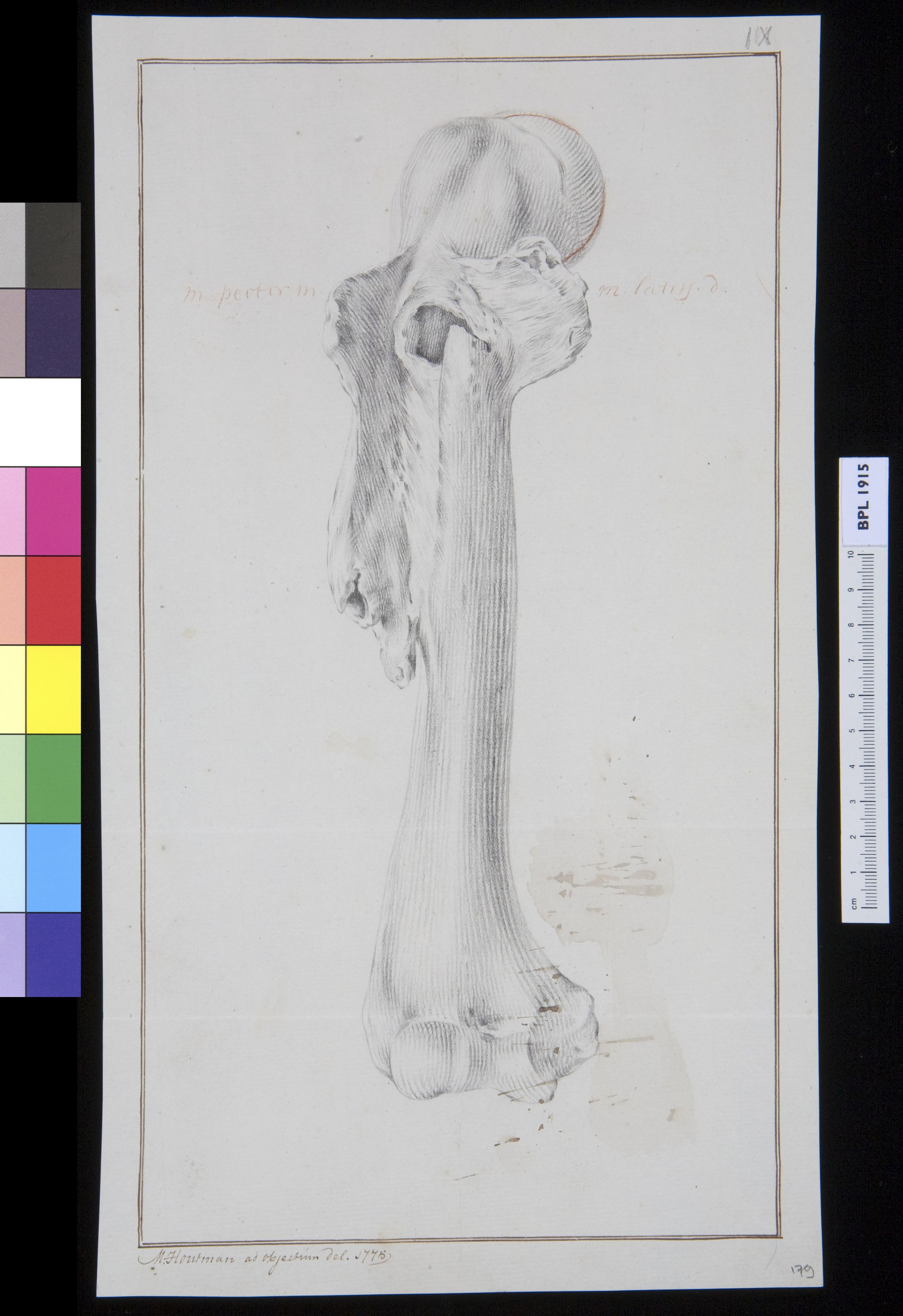 Infected bone (femur?)