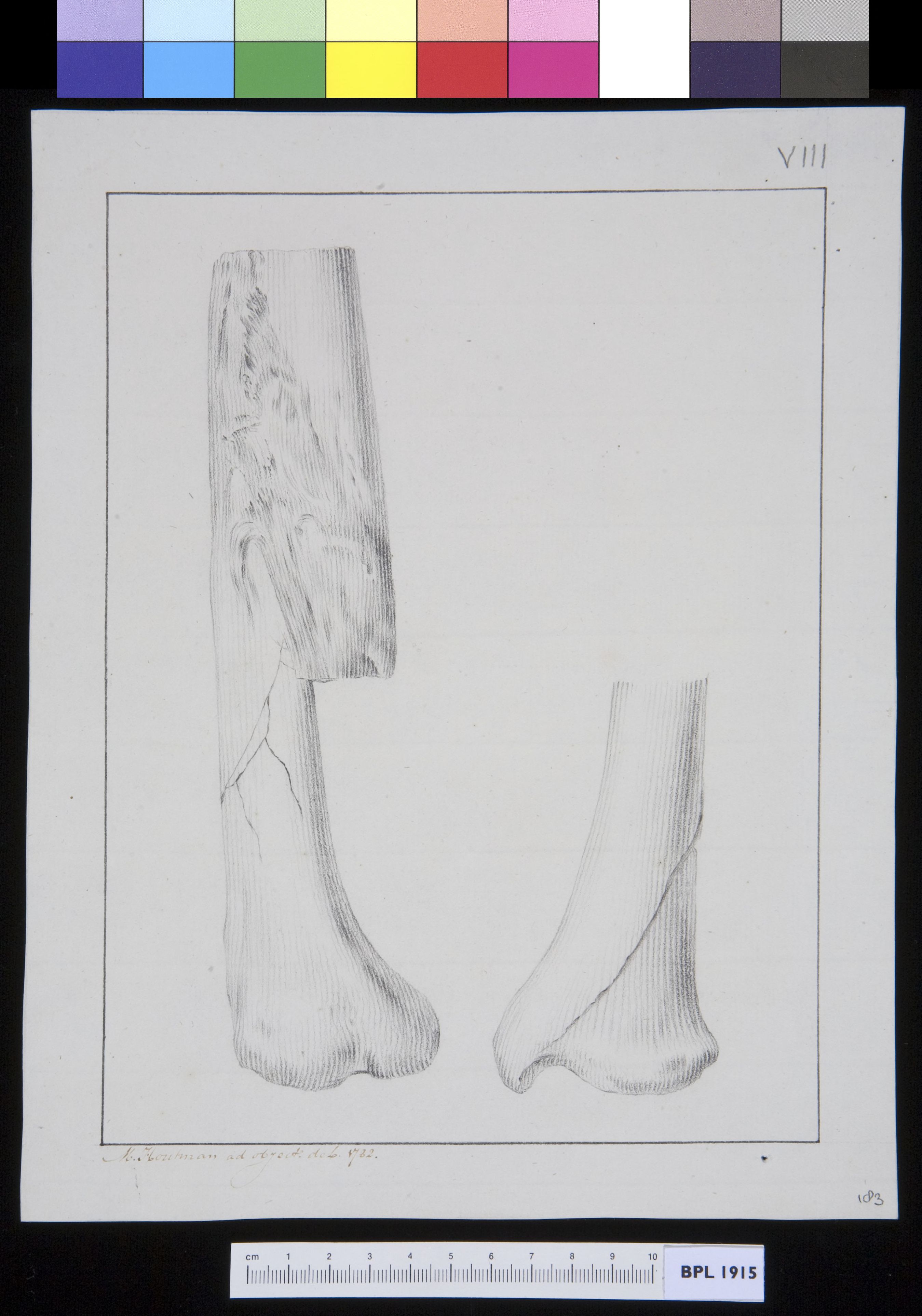 Infected bone