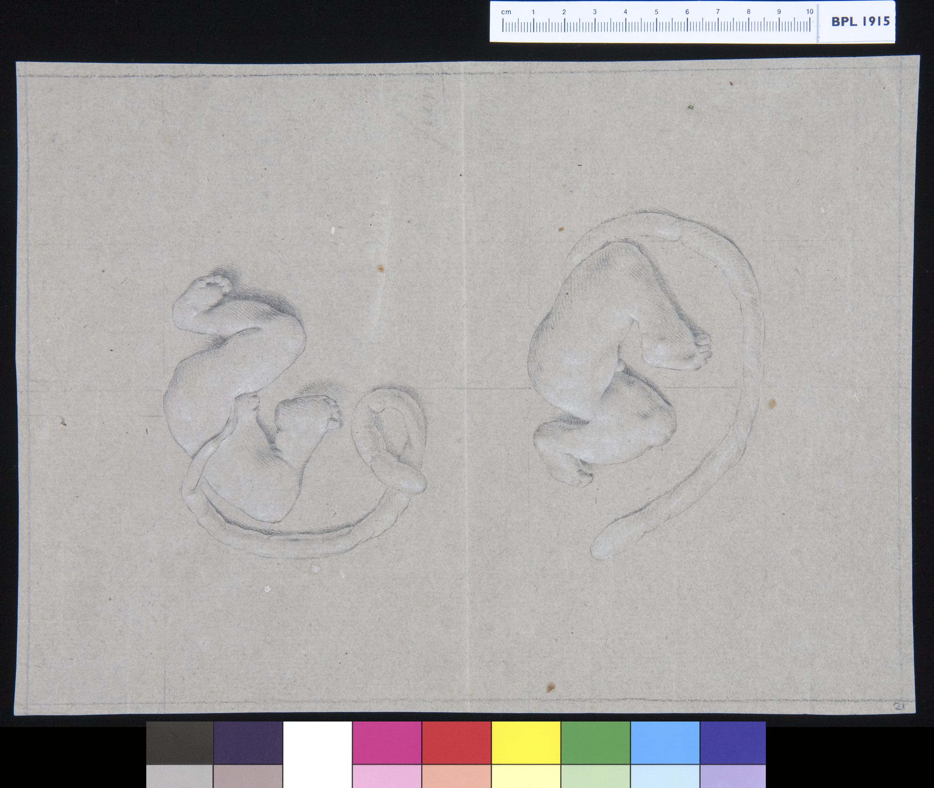 Two views of a deformed foetus with umbilical cord