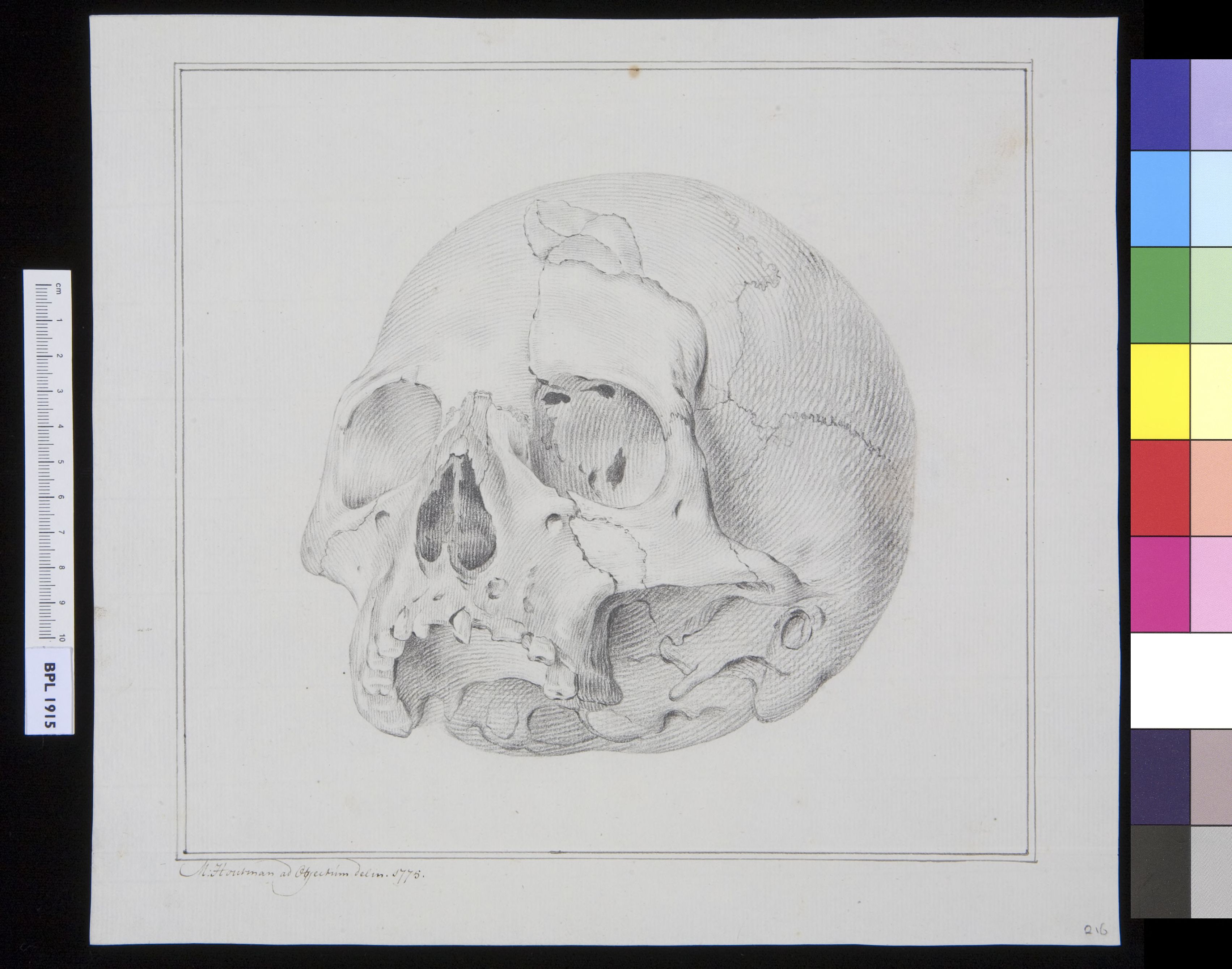 Skull with fractures