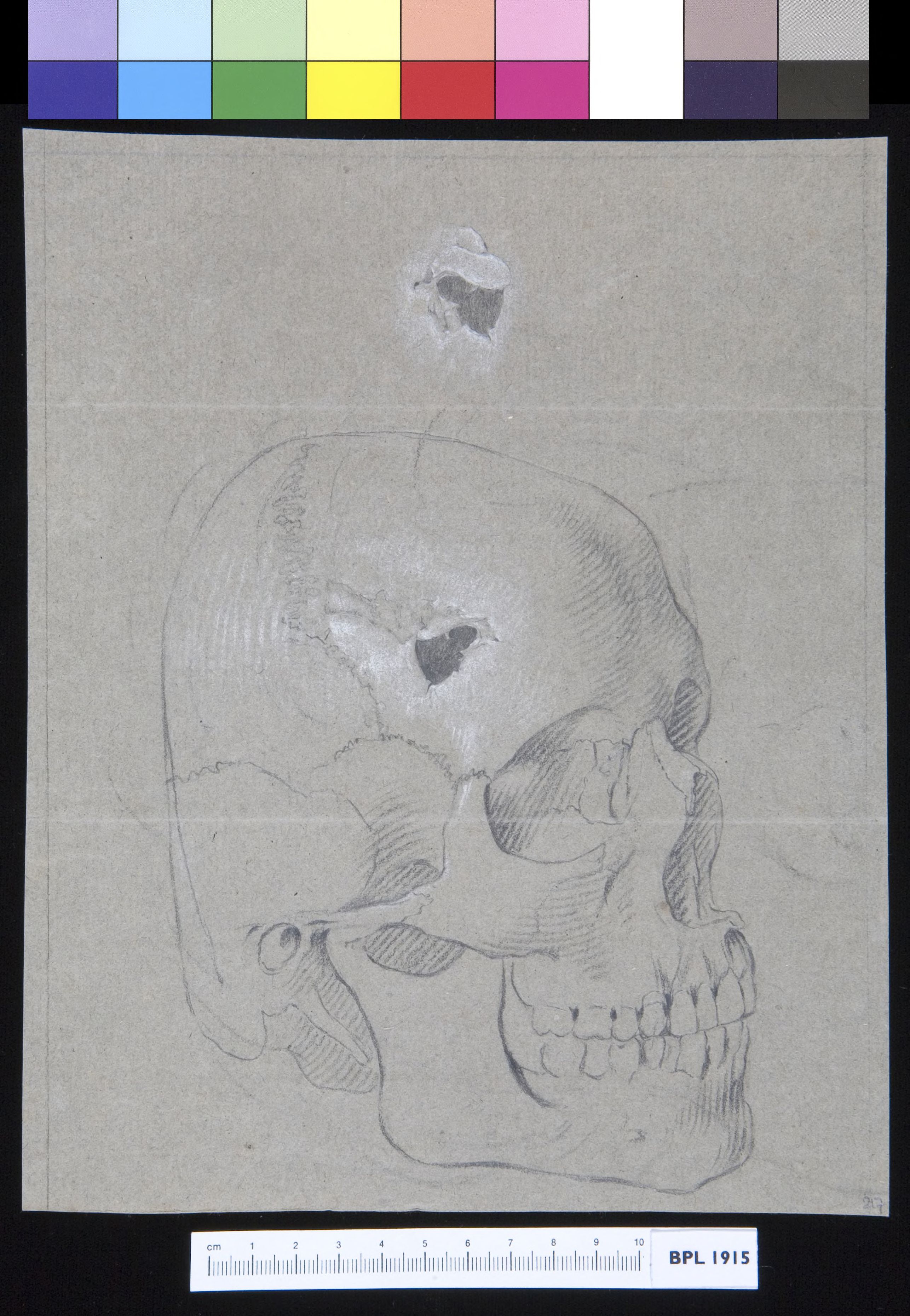 Skull with fracture, plus detail