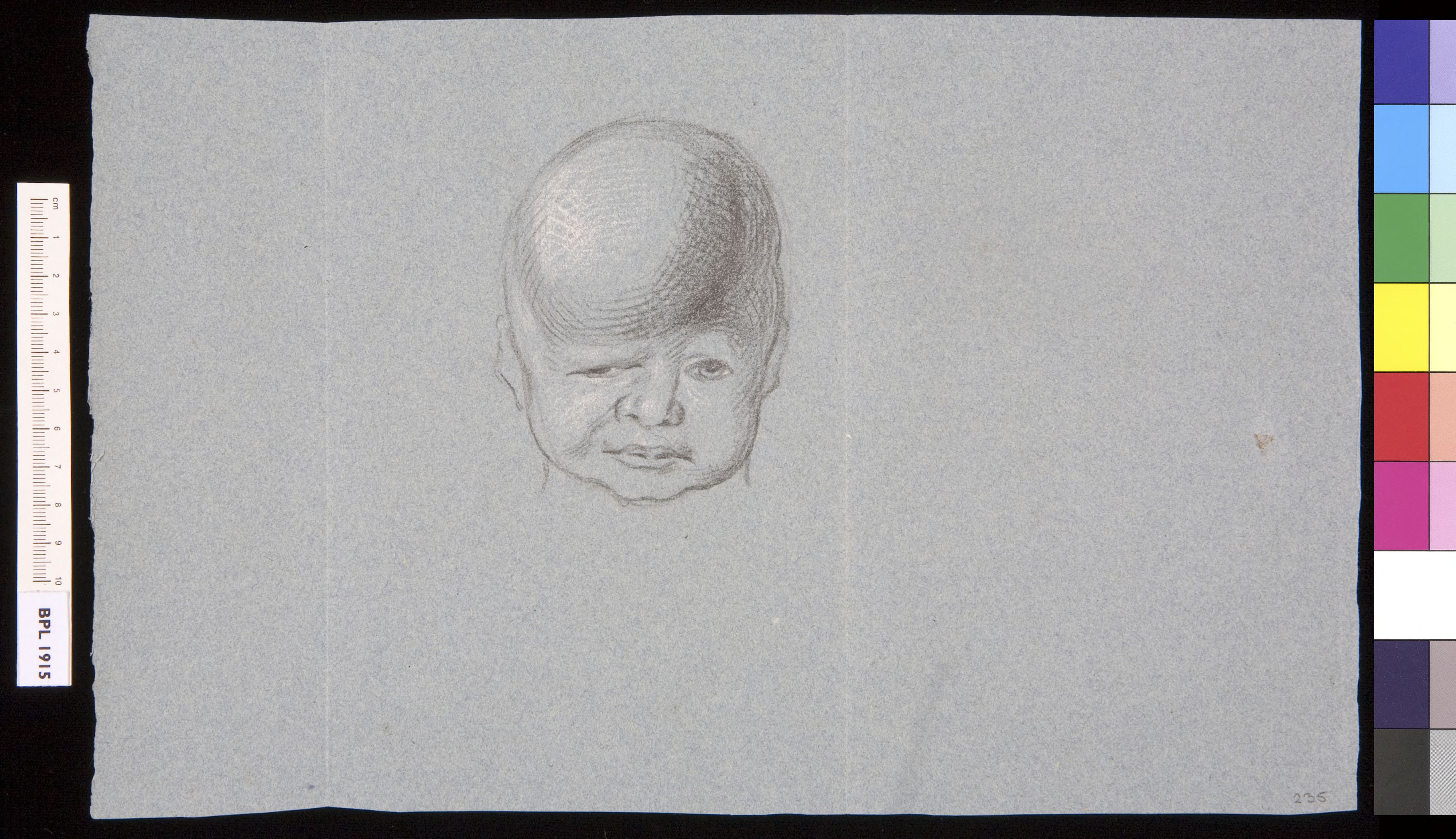 Infant with swelling on its head