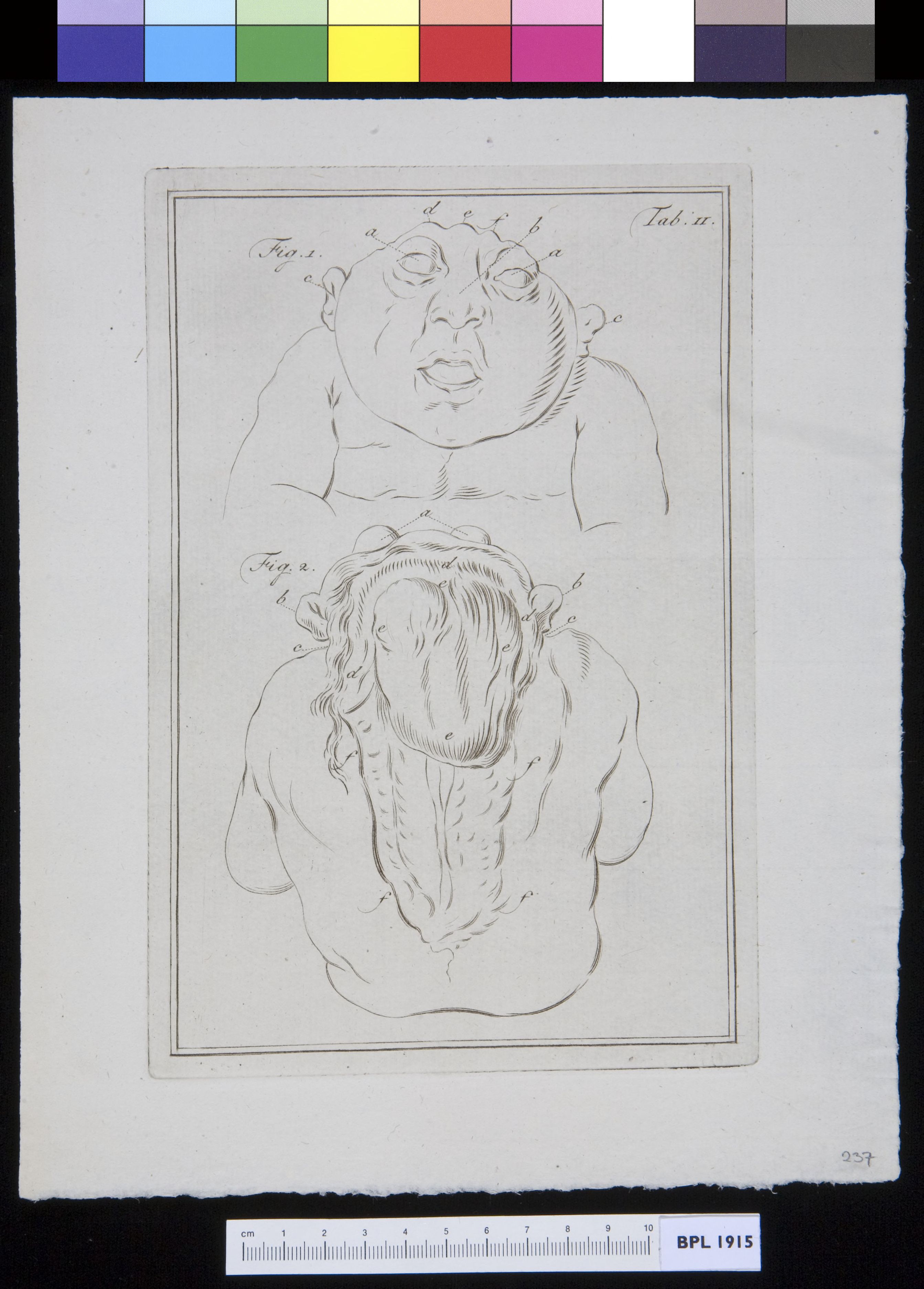 Infant with spina bifida