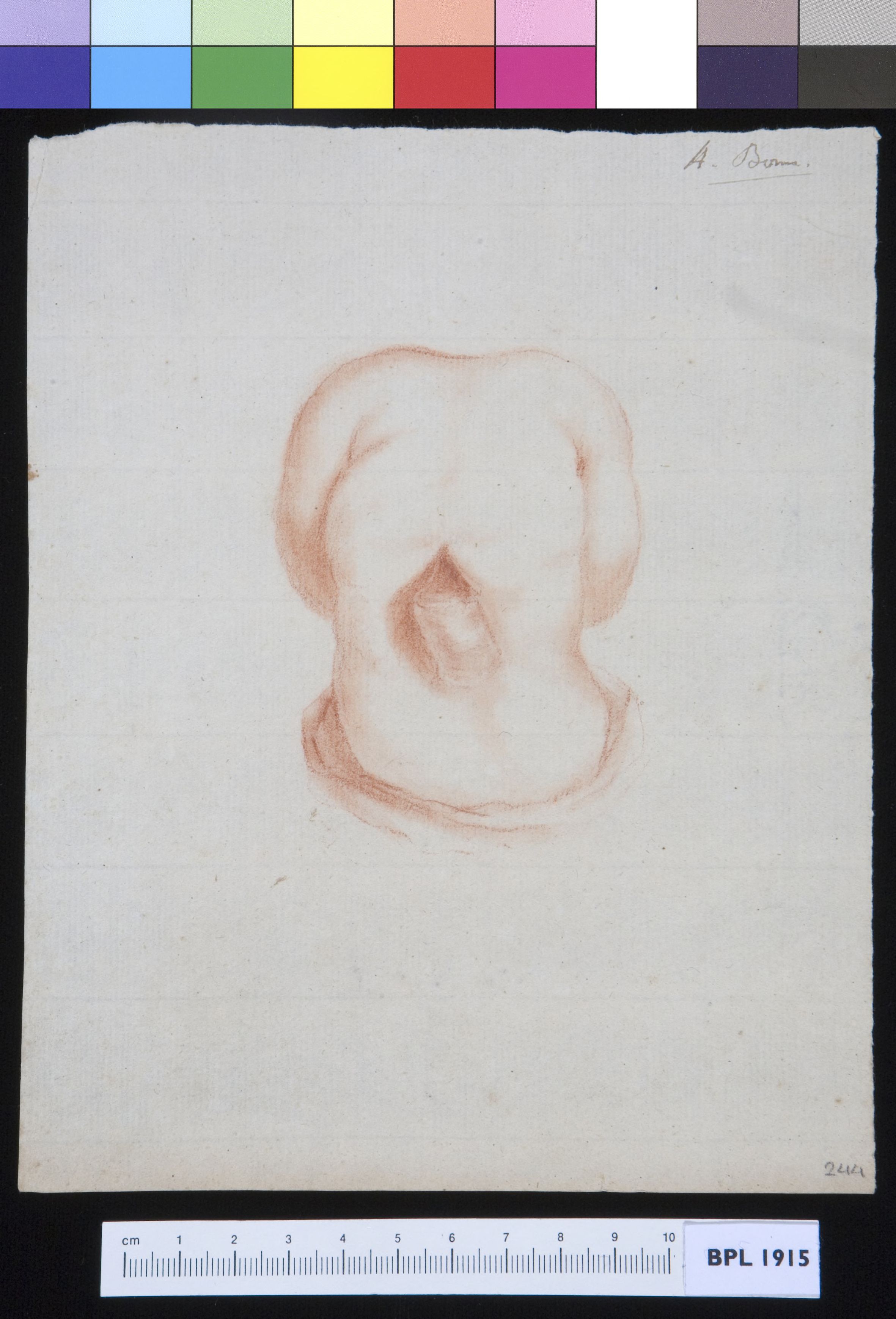 Torso of an infant with spina bifida