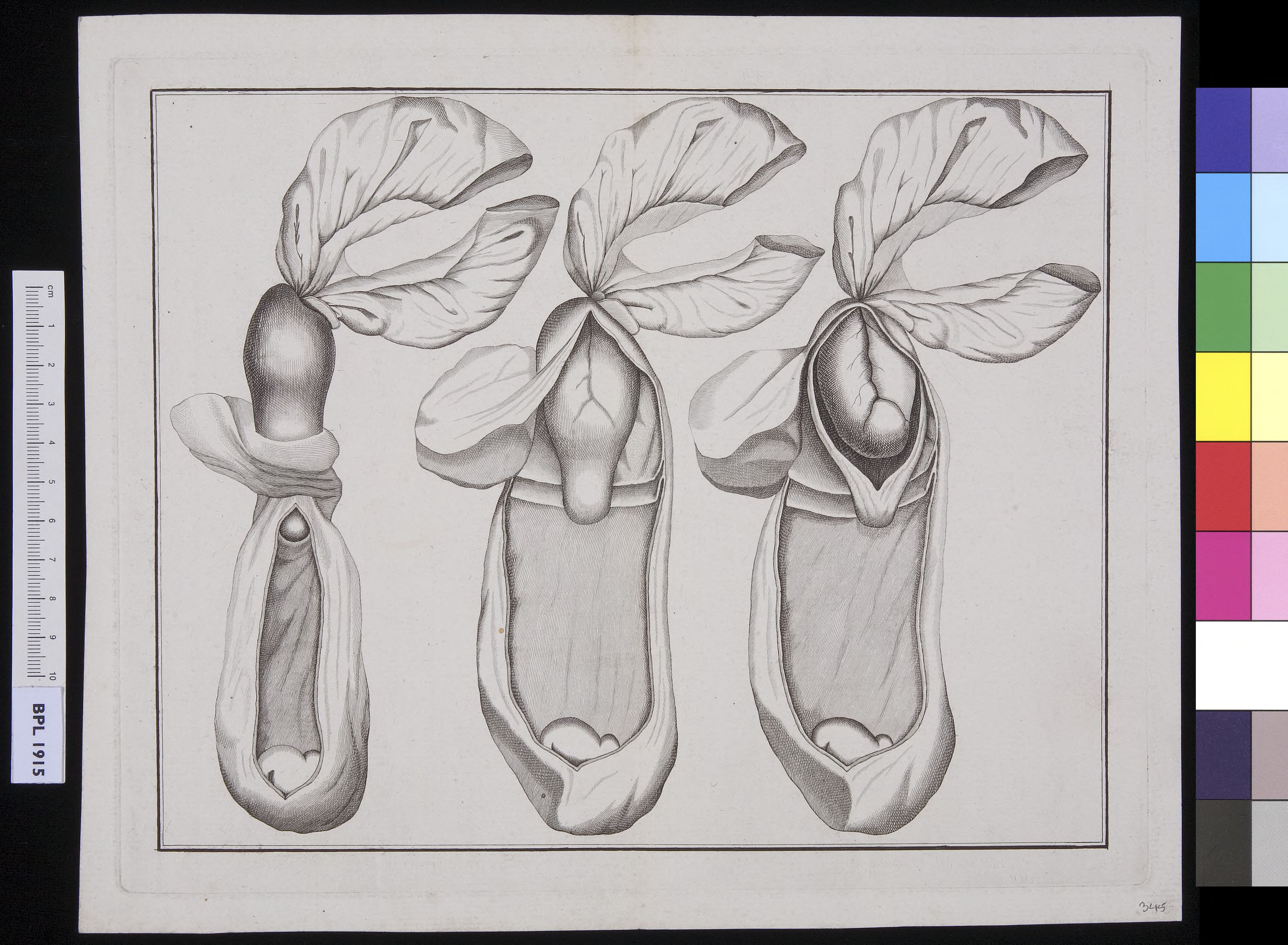 Three images of a hernia inguinalis