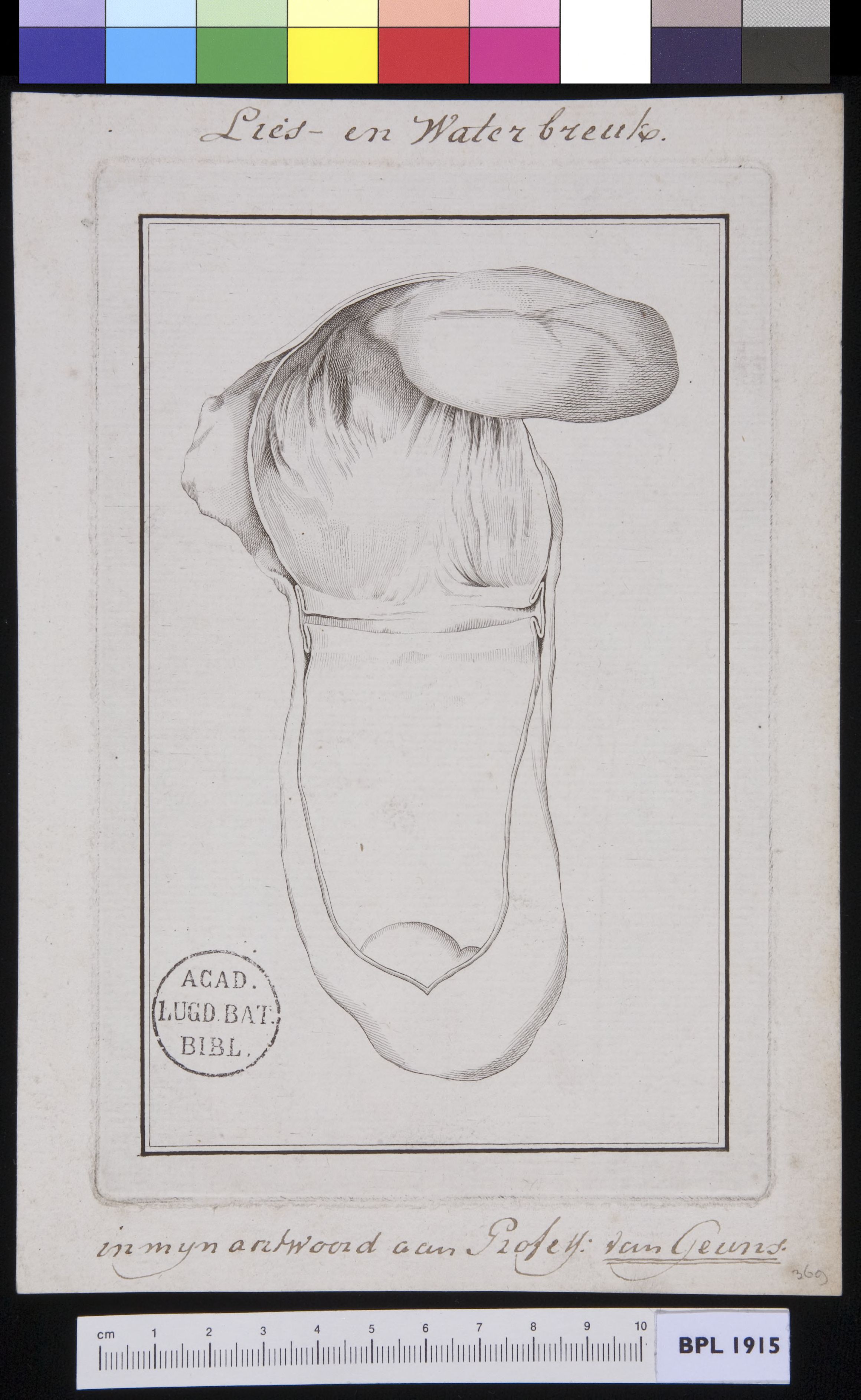 Image of a hernia inguinalis