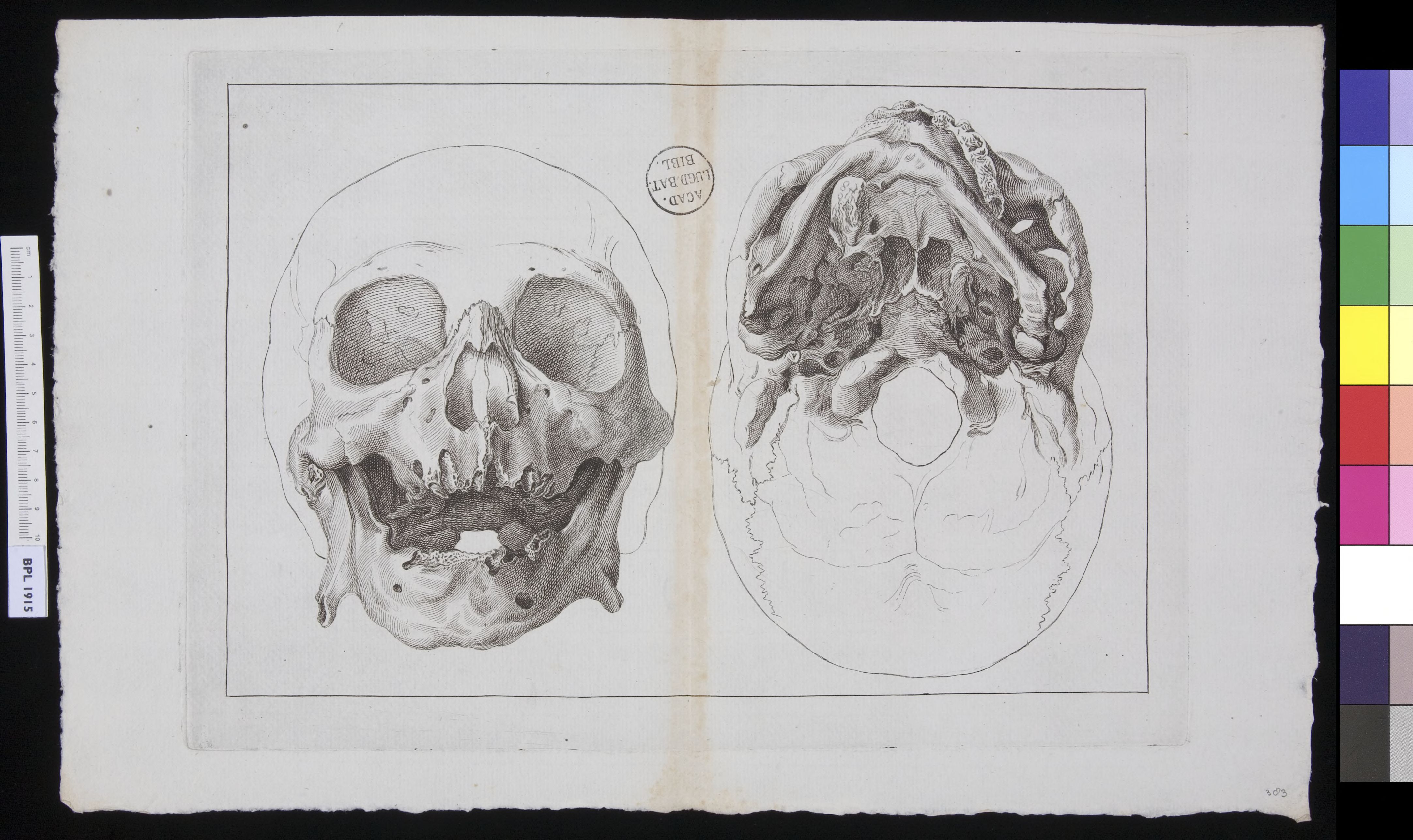 Human skull, deterioration of the jaw bones
