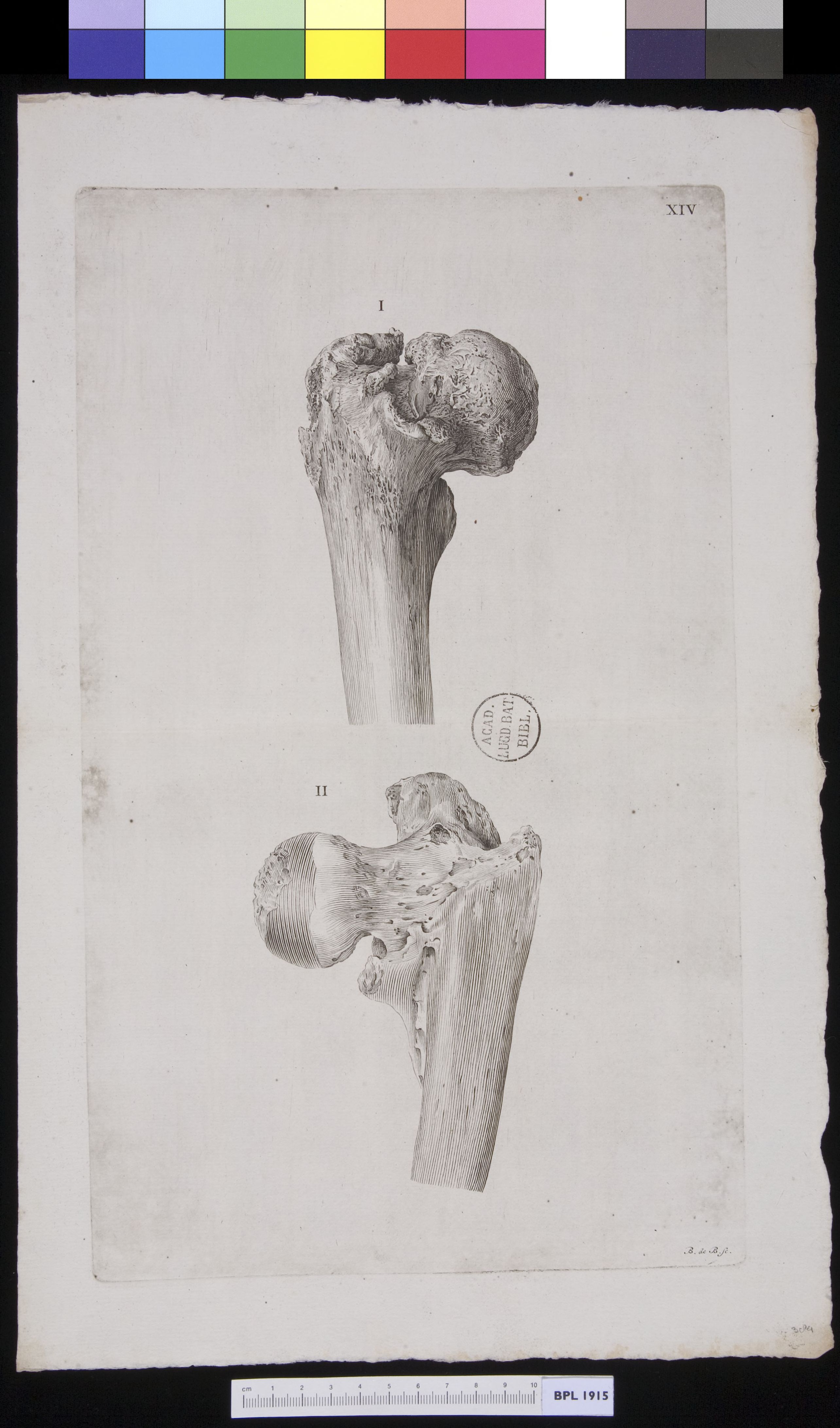 Femur with infection