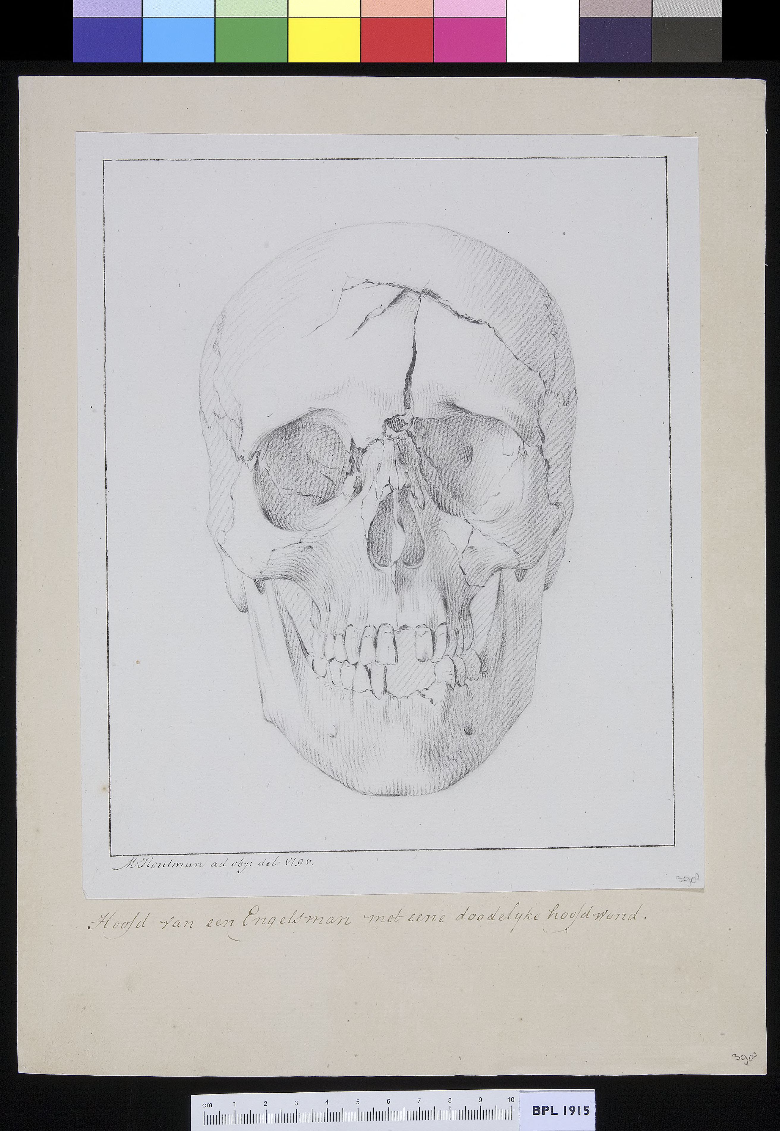 Human skull with fracture